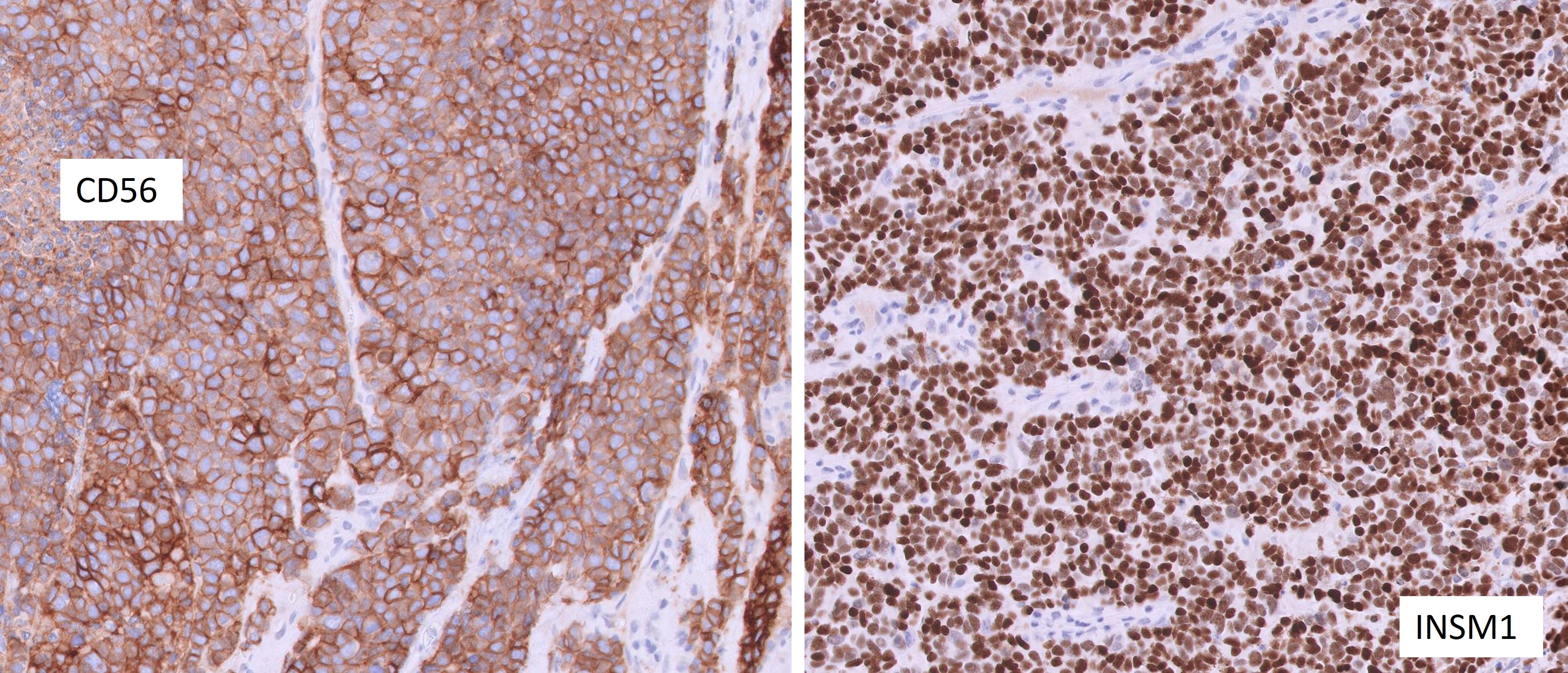 Microscopic image possibly detecting cancerous areas in human tissue