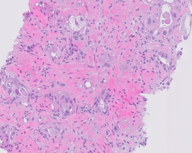 Microscopic image possibly detecting cancerous areas in human tissue