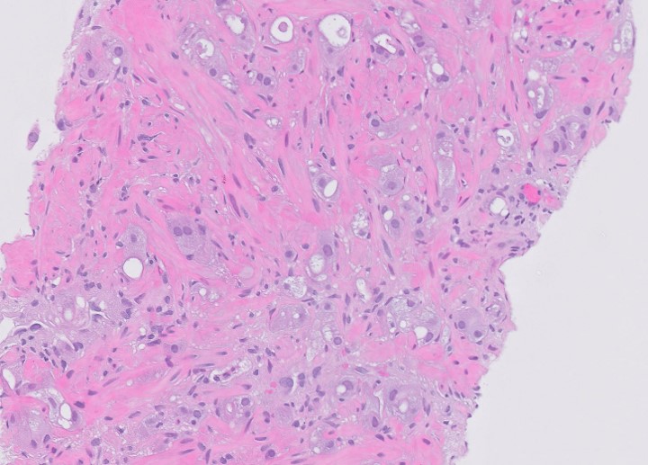 Microscopic image possibly detecting cancerous areas in human tissue