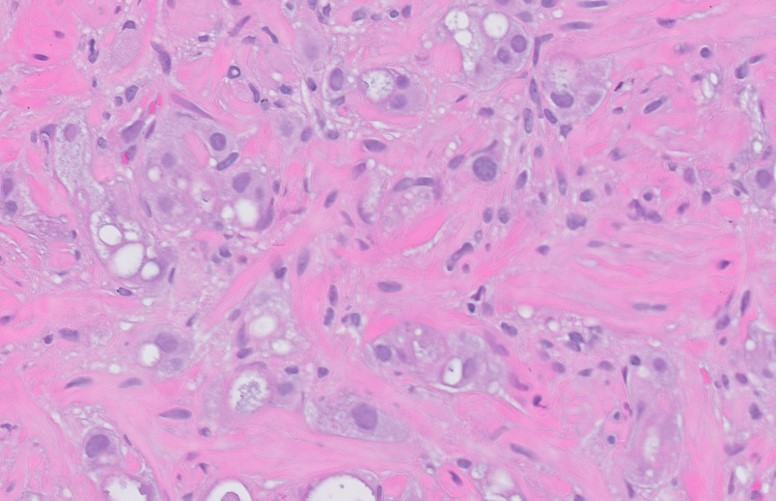 Microscopic image possibly detecting cancerous areas in human tissue