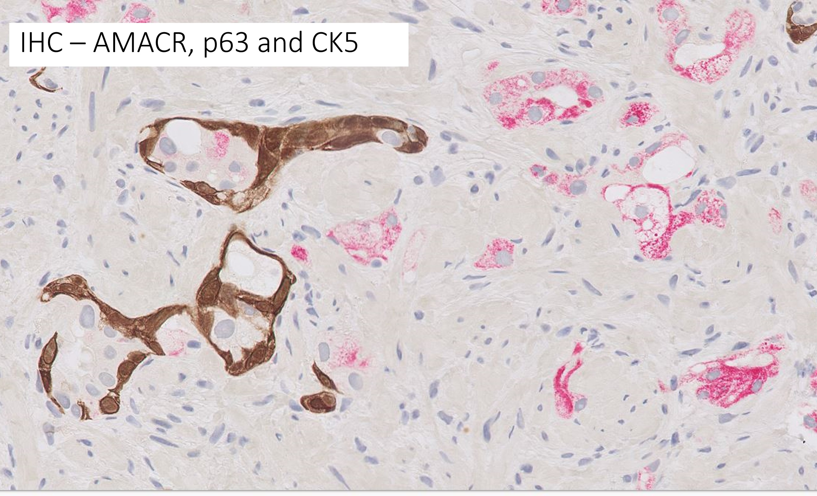 Microscopic image possibly detecting cancerous areas in human tissue