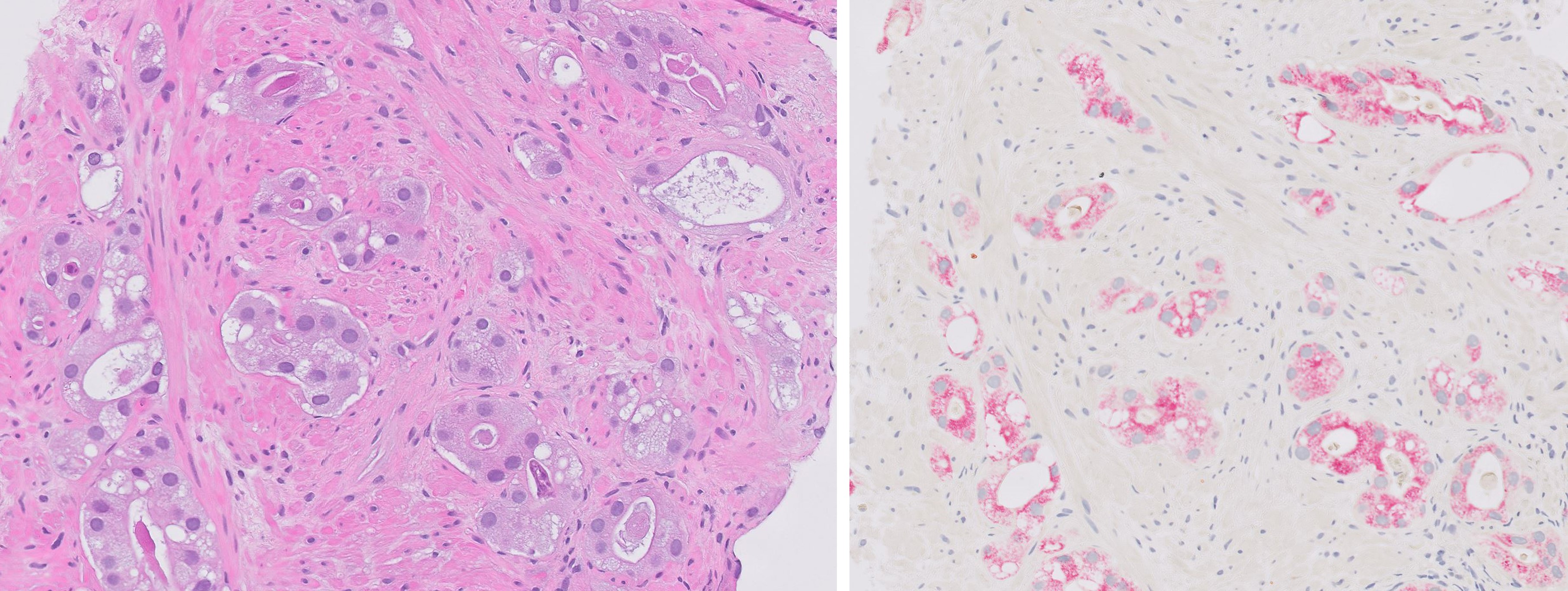Microscopic image possibly detecting cancerous areas in human tissue