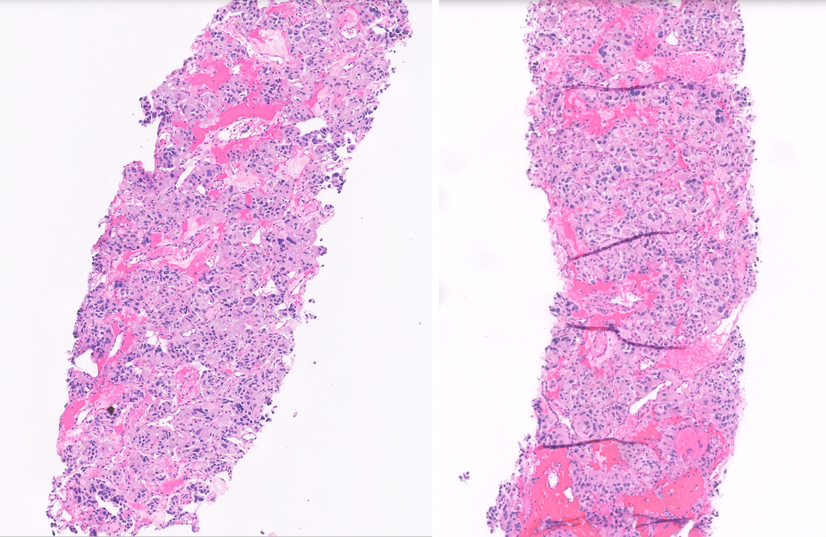 Microscopic image possibly detecting cancerous areas in human tissue