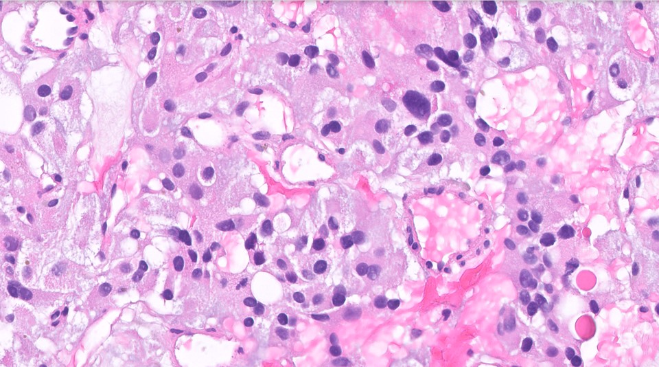 Microscopic image possibly detecting cancerous areas in human tissue