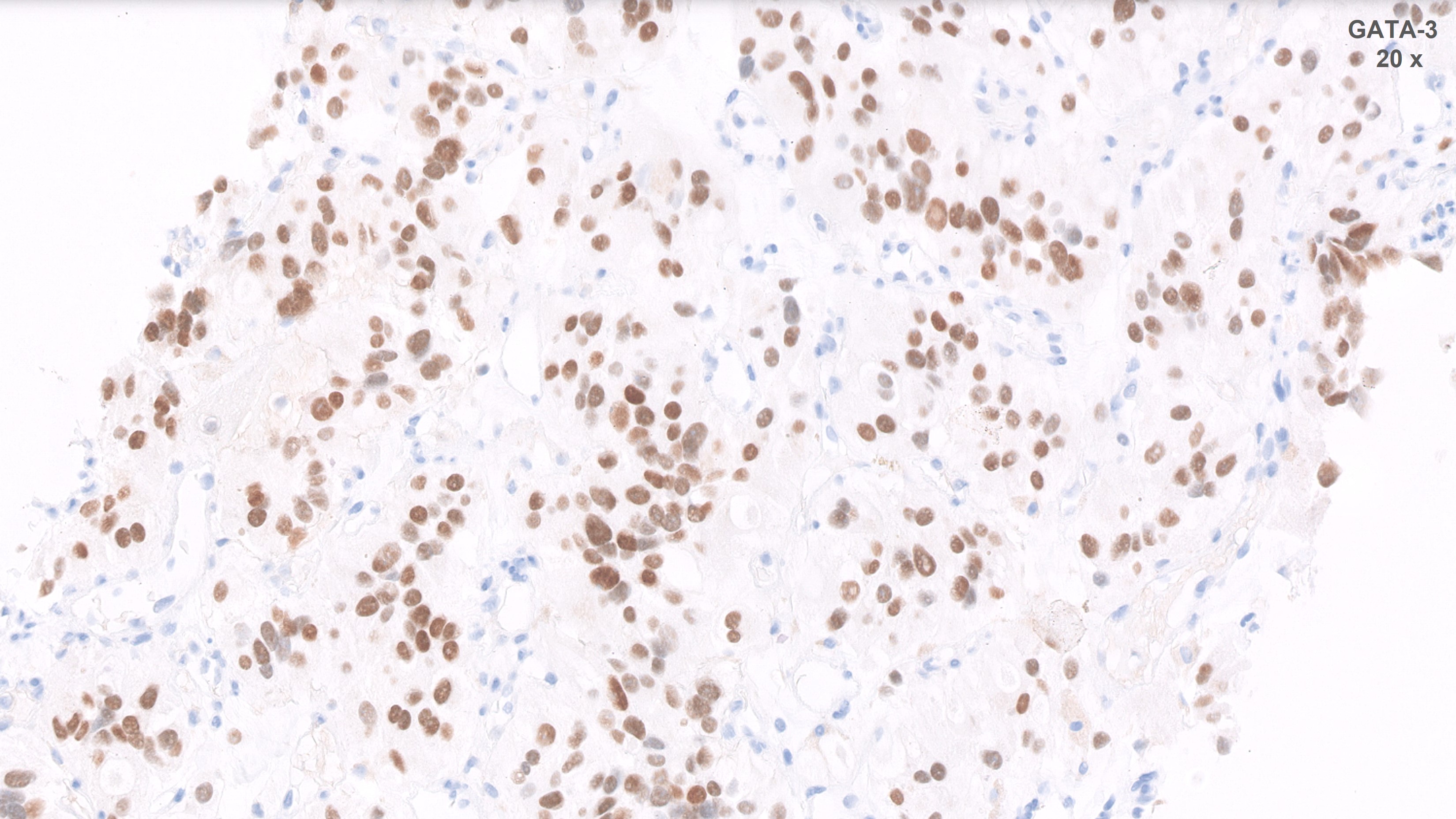 Microscopic image possibly detecting cancerous areas in human tissue