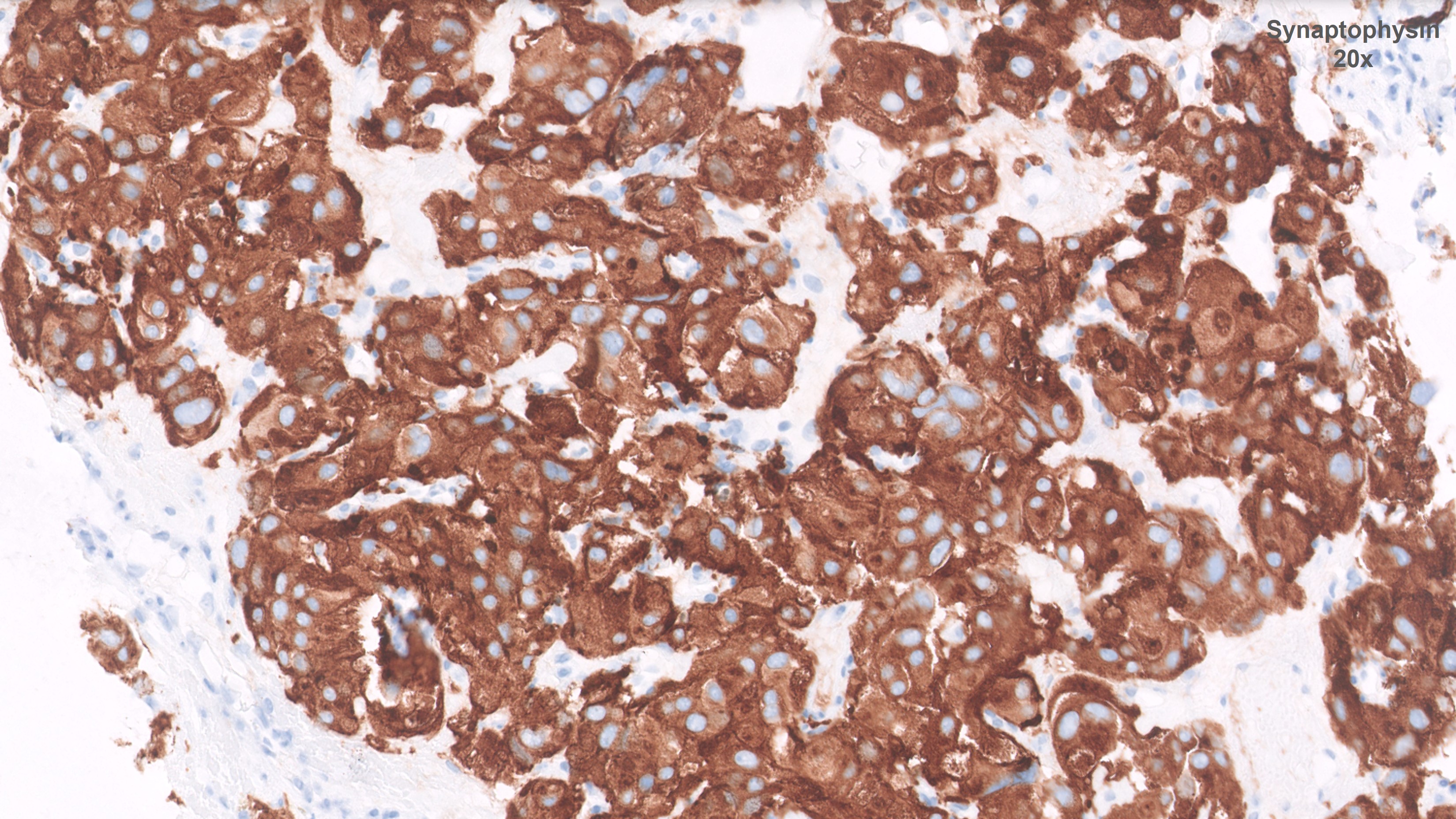 Microscopic image possibly detecting cancerous areas in human tissue