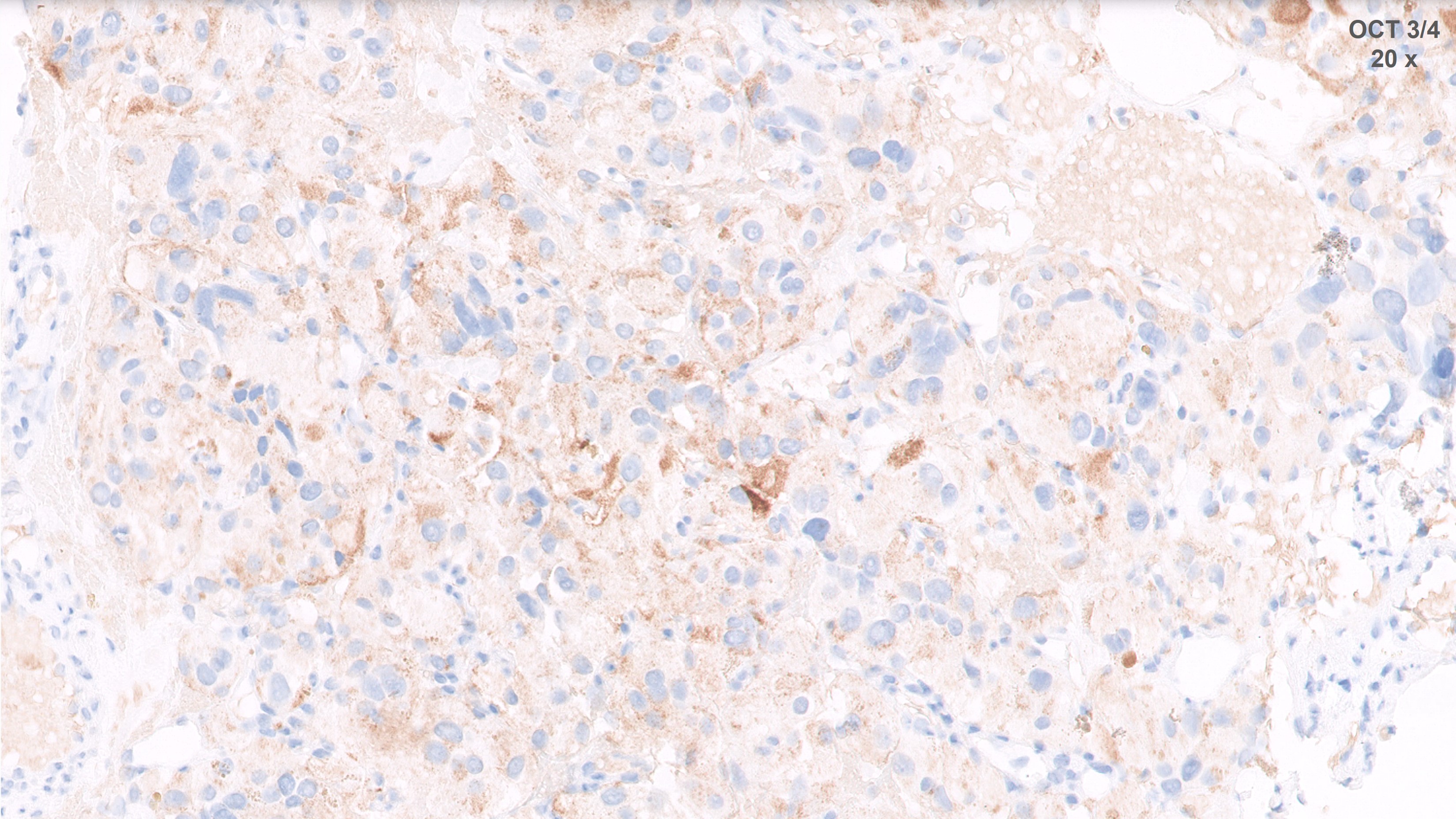 Microscopic image possibly detecting cancerous areas in human tissue
