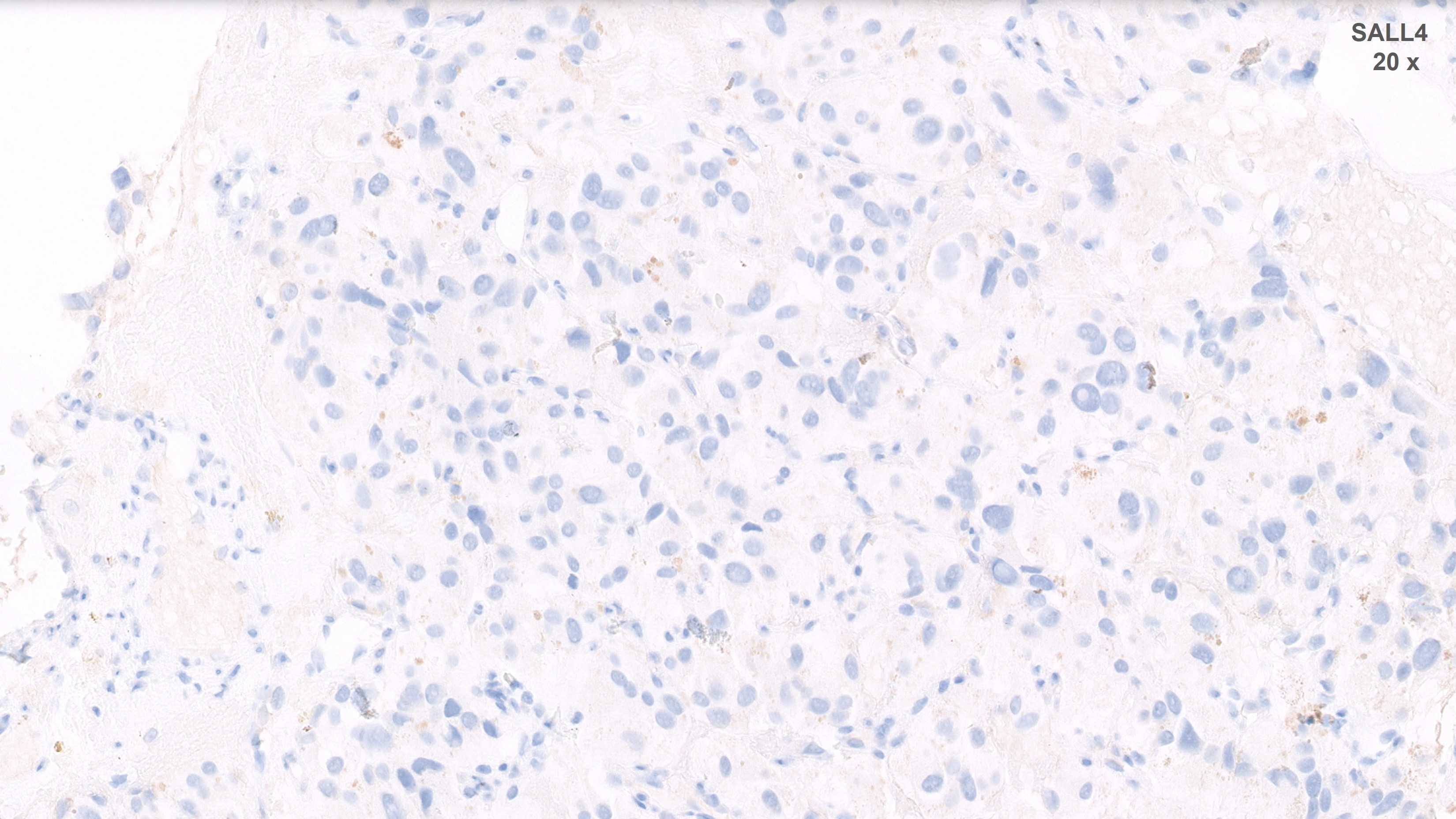 Microscopic image possibly detecting cancerous areas in human tissue