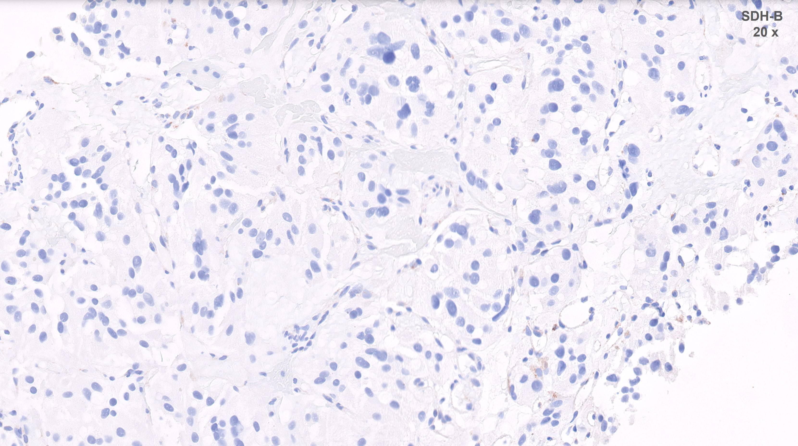 Microscopic image possibly detecting cancerous areas in human tissue