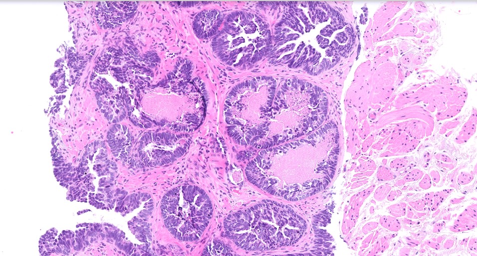 Microscopic image possibly detecting cancerous areas in human tissue