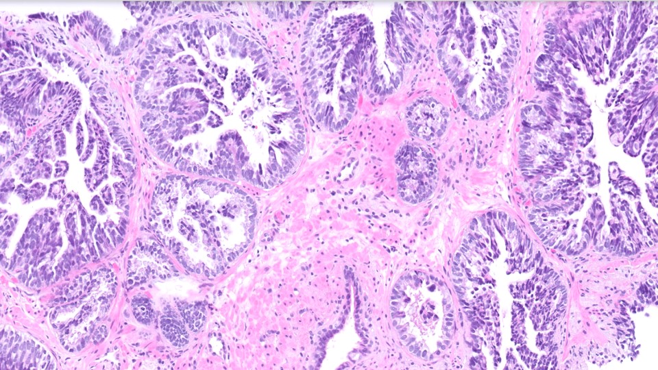 Microscopic image possibly detecting cancerous areas in human tissue