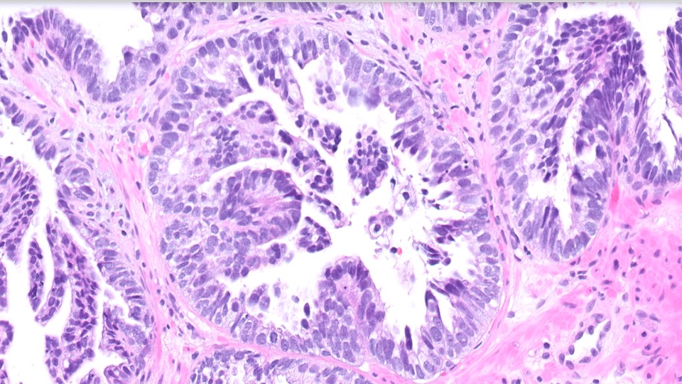 Microscopic image possibly detecting cancerous areas in human tissue