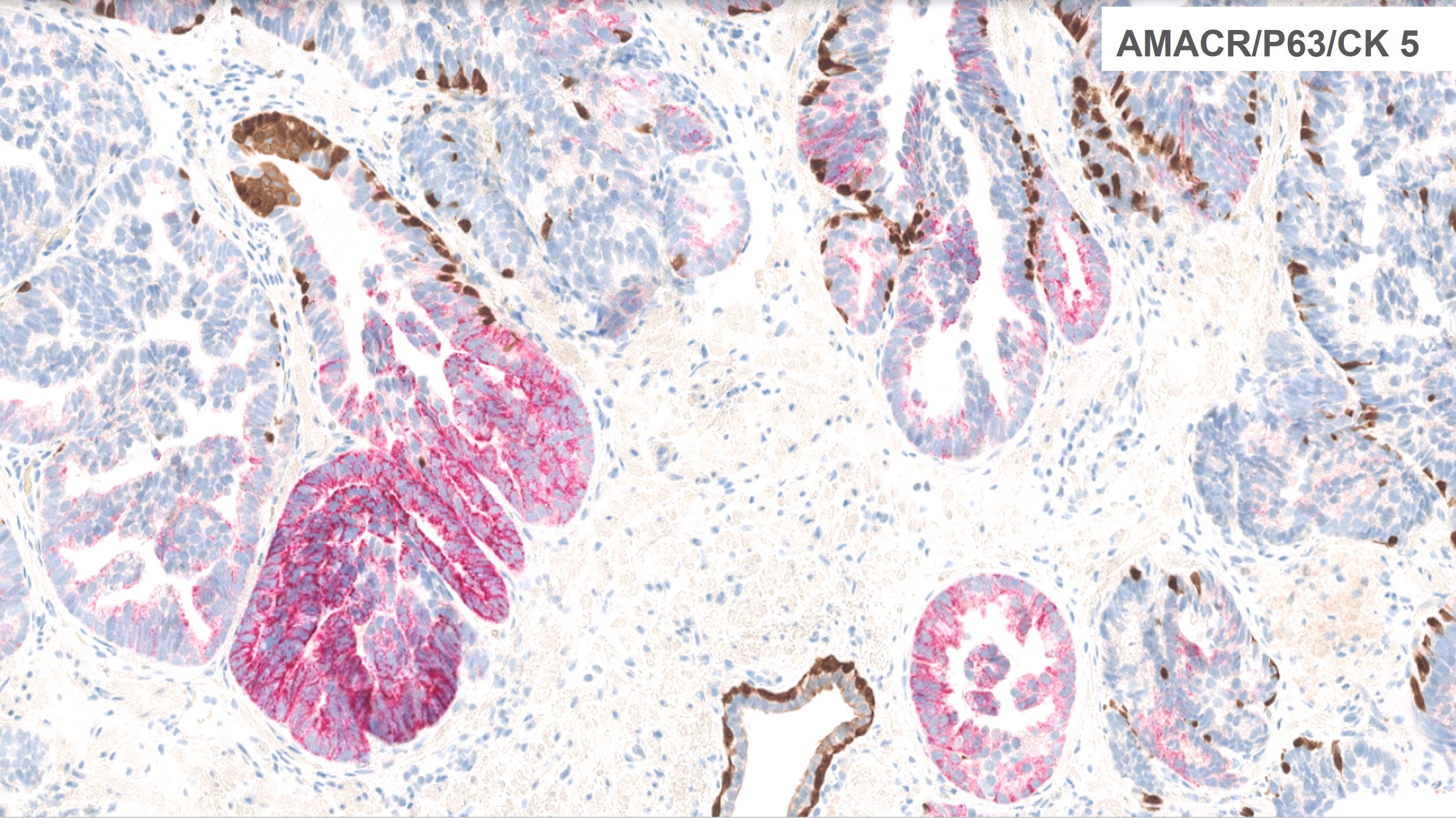 Microscopic image possibly detecting cancerous areas in human tissue