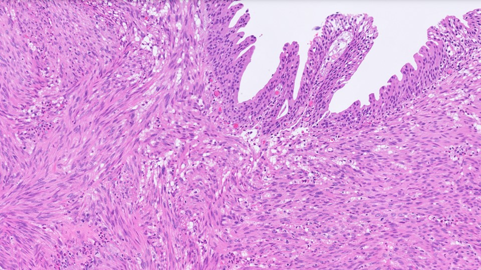Microscopic image possibly detecting cancerous areas in human tissue