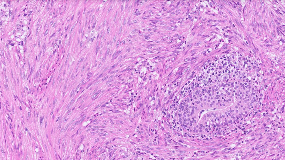 Microscopic image possibly detecting cancerous areas in human tissue