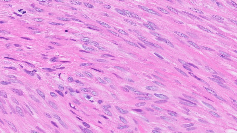 Microscopic image possibly detecting cancerous areas in human tissue