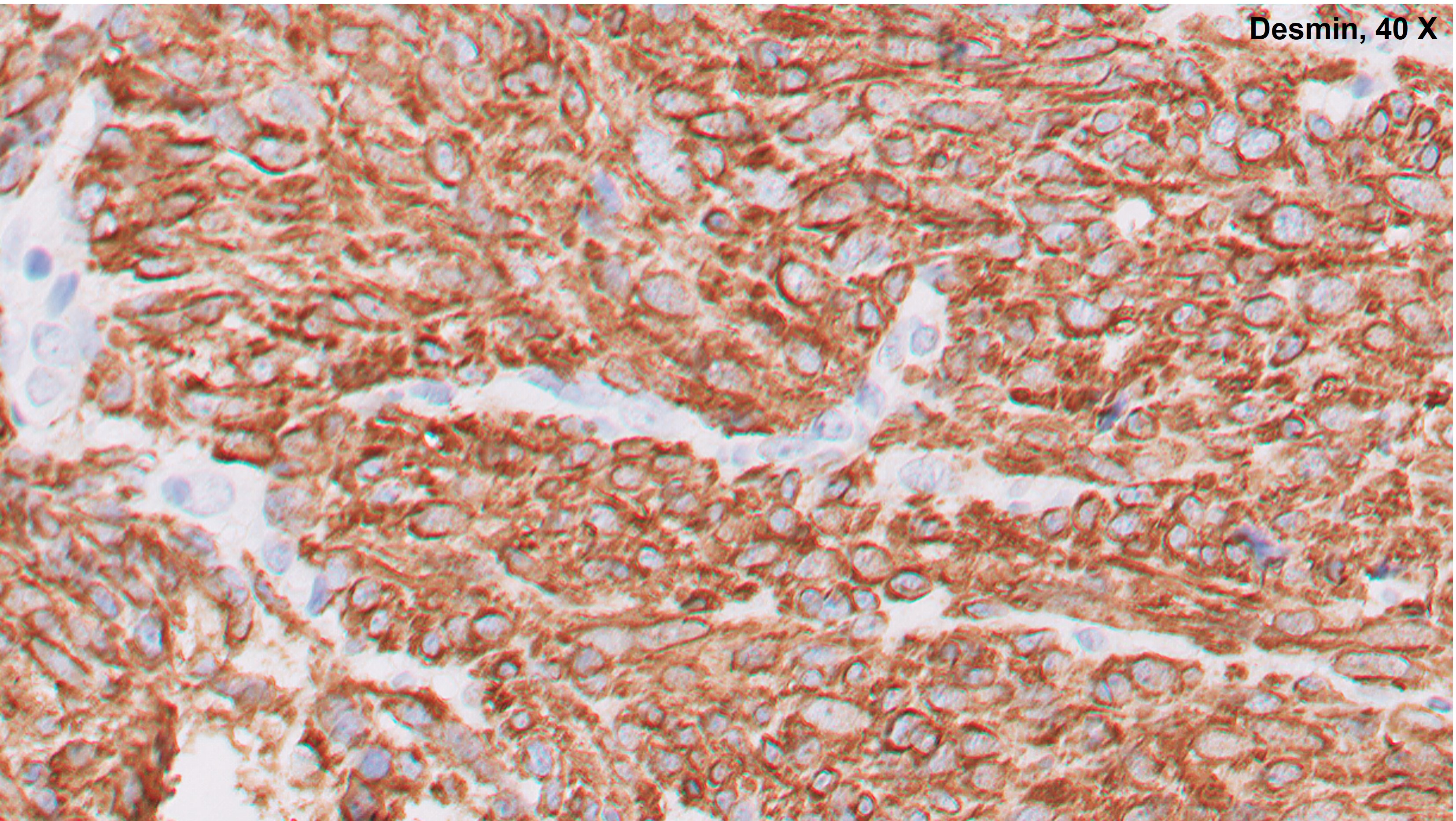 Microscopic image possibly detecting cancerous areas in human tissue