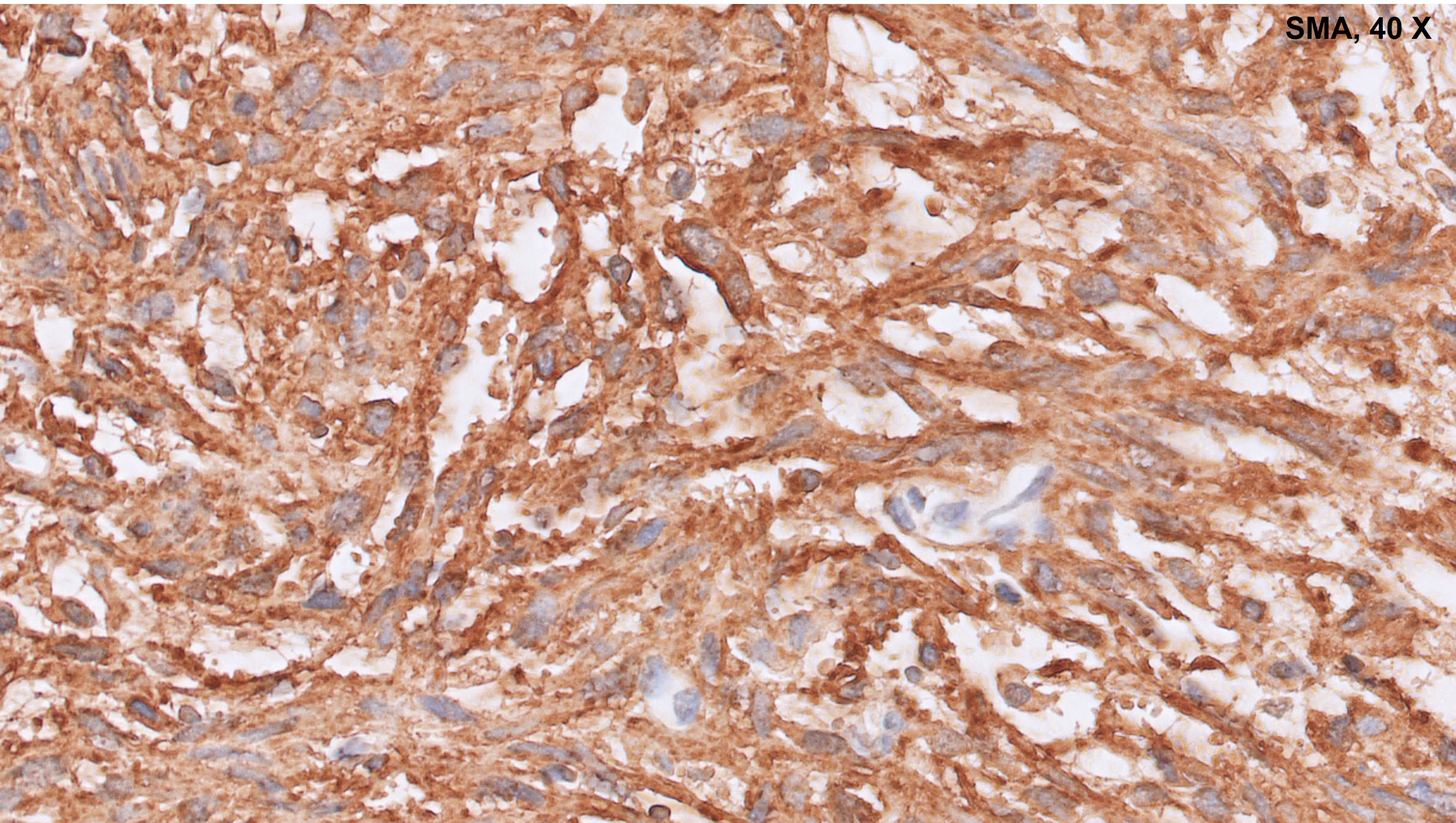 Microscopic image possibly detecting cancerous areas in human tissue