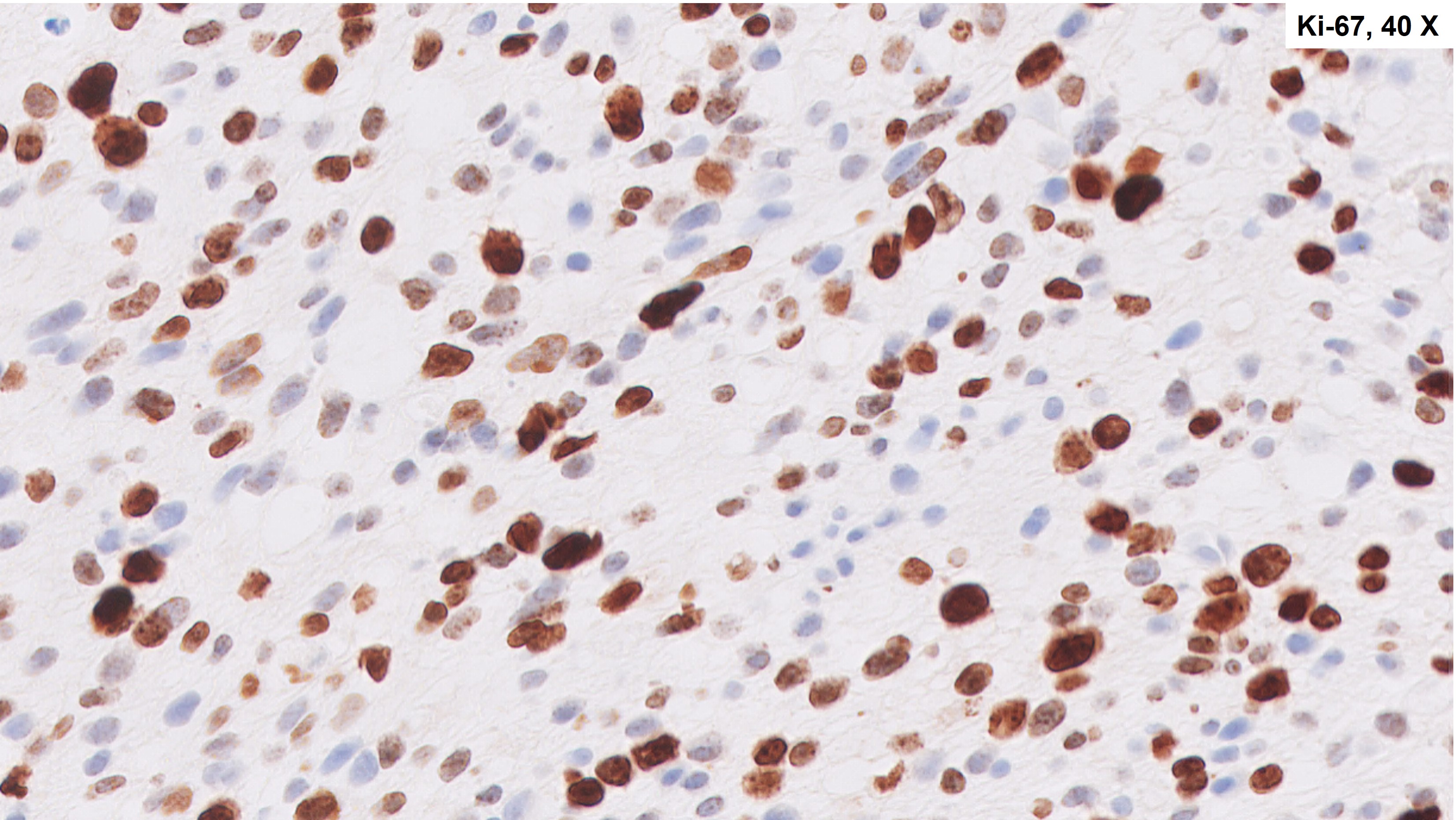 Microscopic image possibly detecting cancerous areas in human tissue