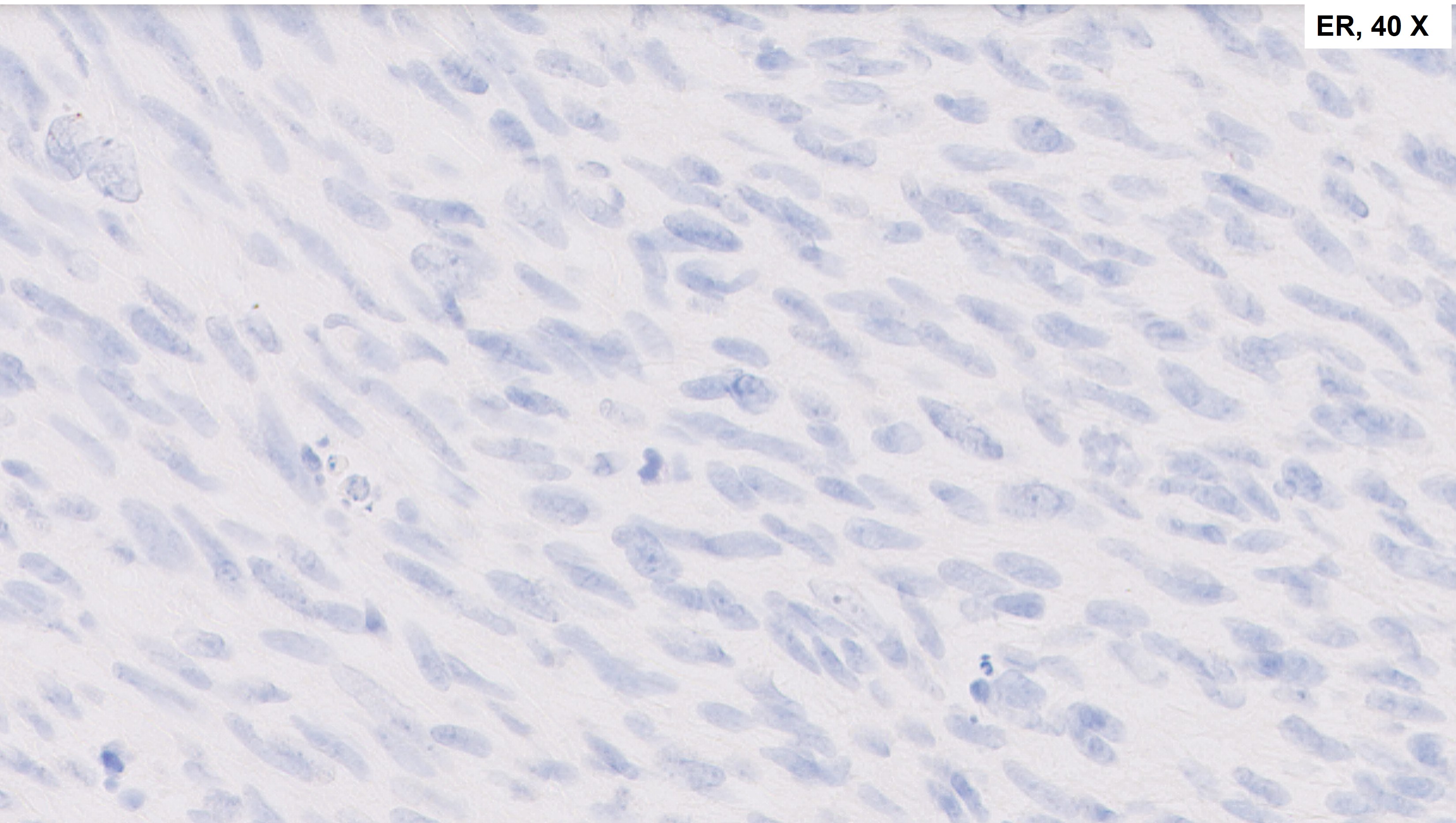 Microscopic image possibly detecting cancerous areas in human tissue