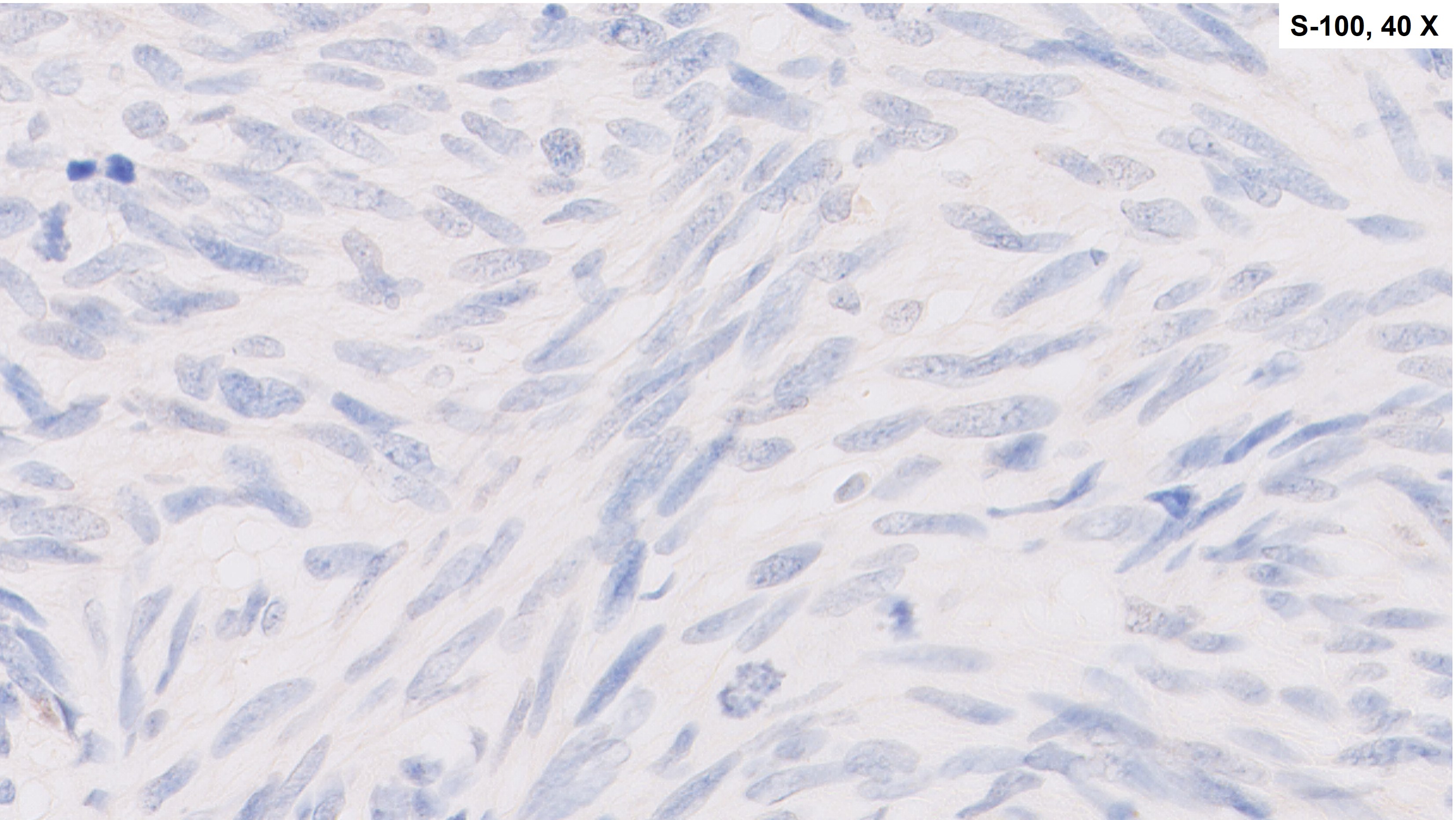 Microscopic image possibly detecting cancerous areas in human tissue