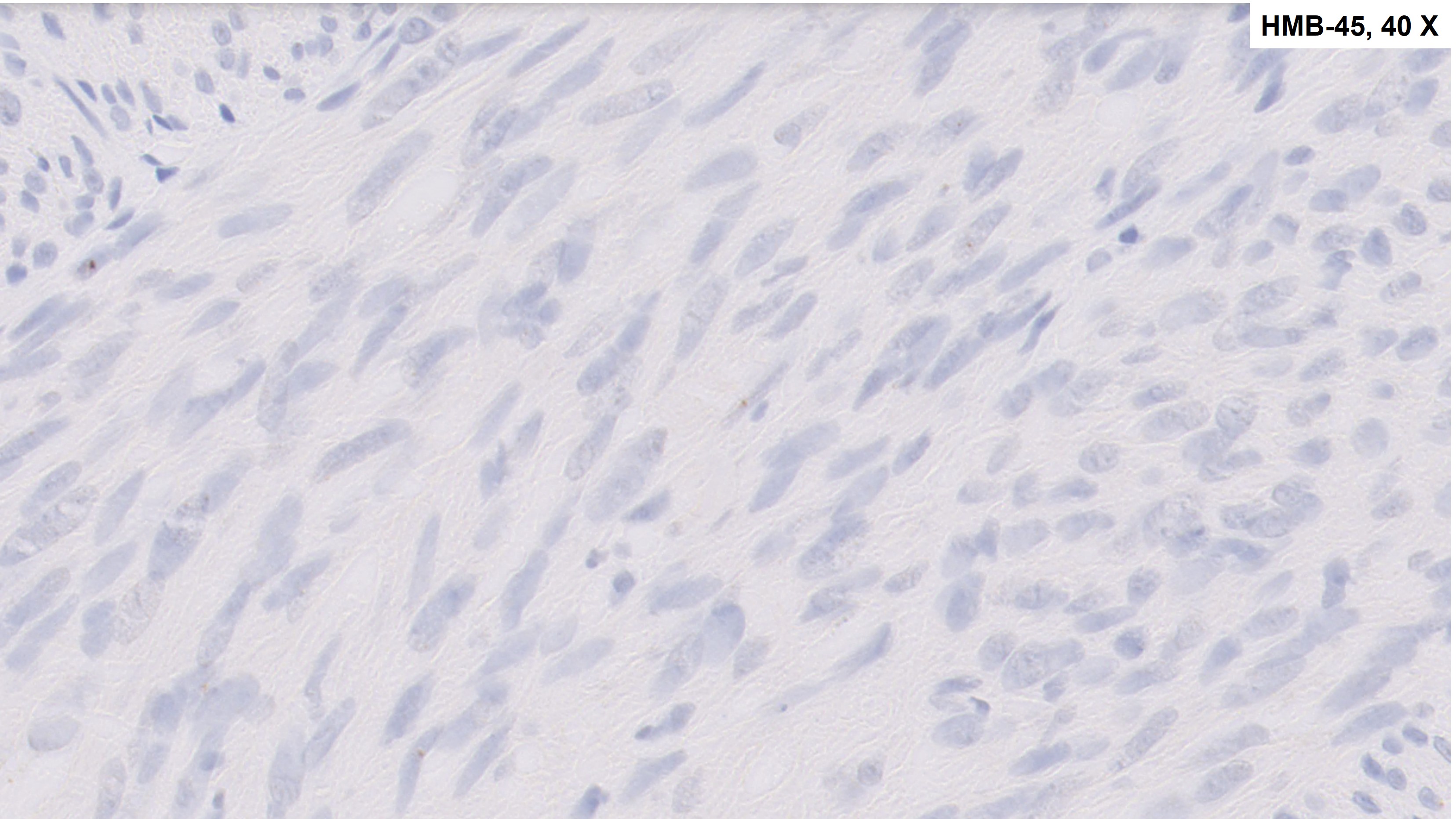 Microscopic image possibly detecting cancerous areas in human tissue