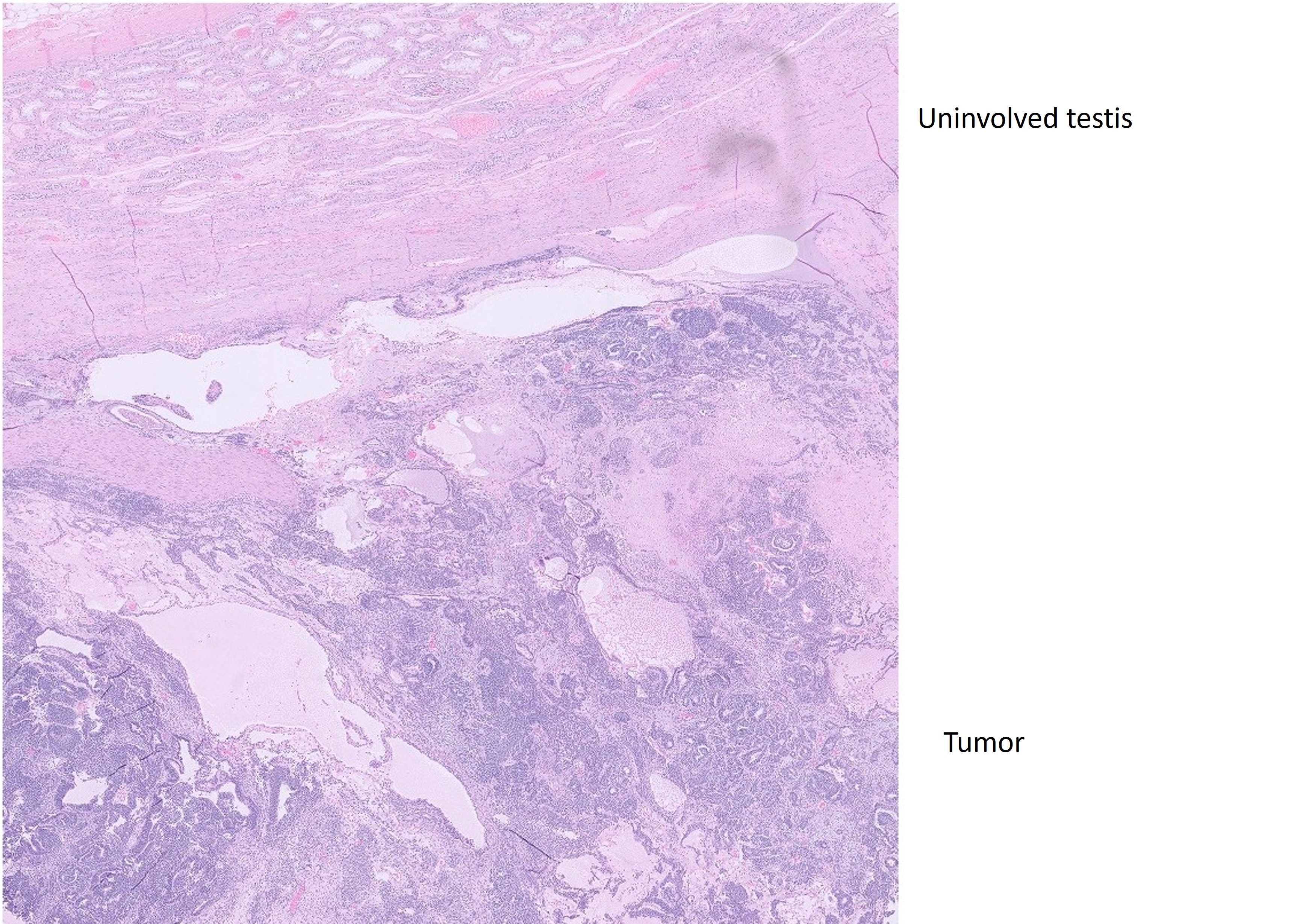 Microscopic image possibly detecting cancerous areas in human tissue