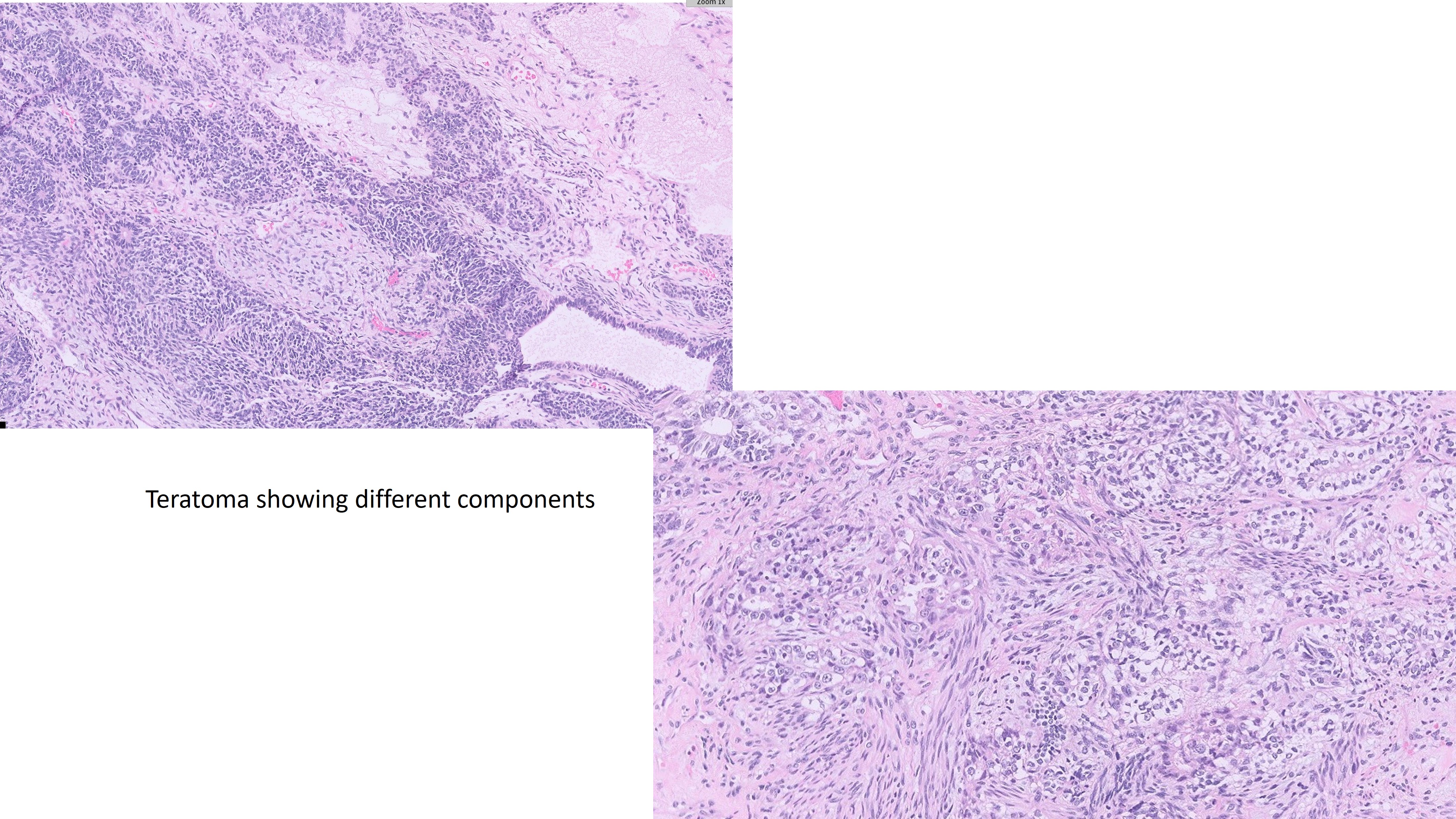 Microscopic image possibly detecting cancerous areas in human tissue