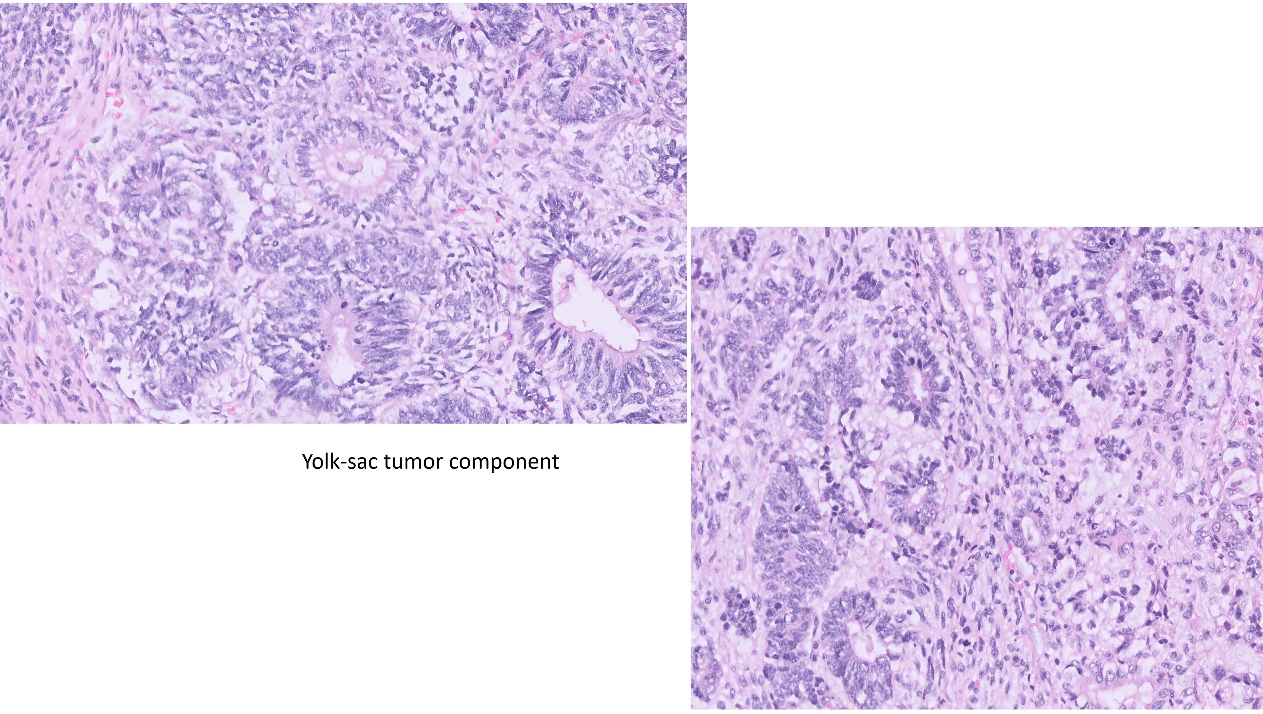 Microscopic image possibly detecting cancerous areas in human tissue