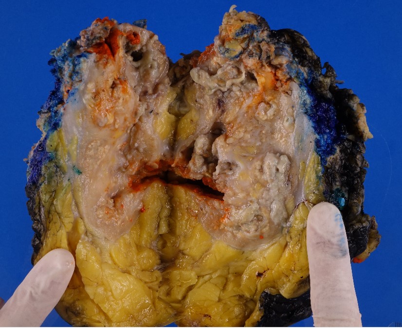 Microscopic image possibly detecting cancerous areas in human tissue