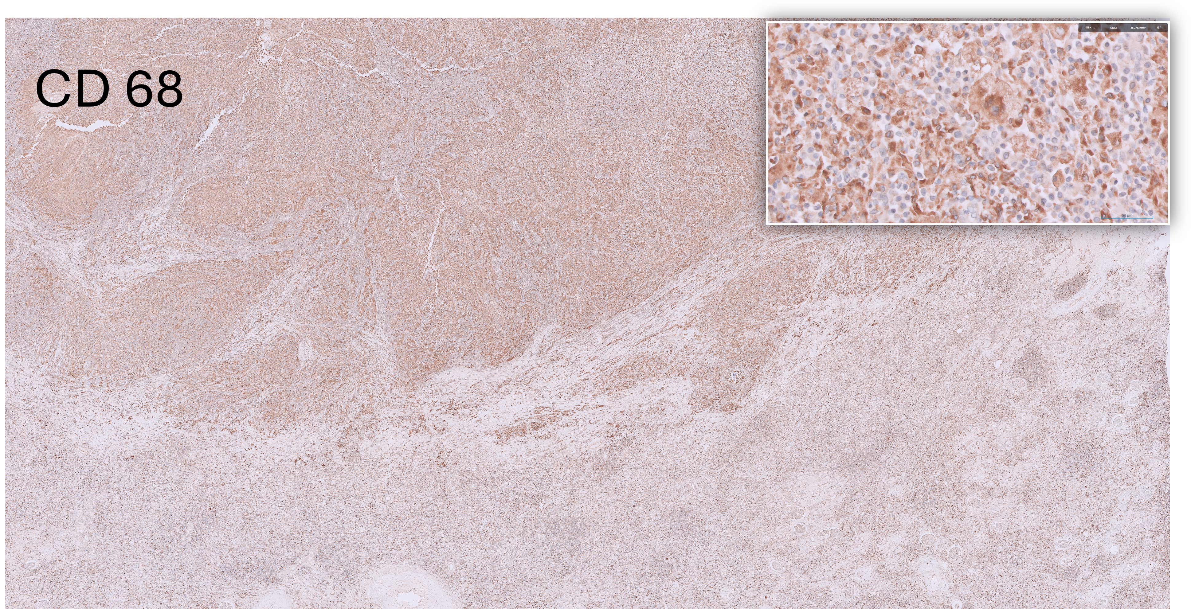 Microscopic image possibly detecting cancerous areas in human tissue