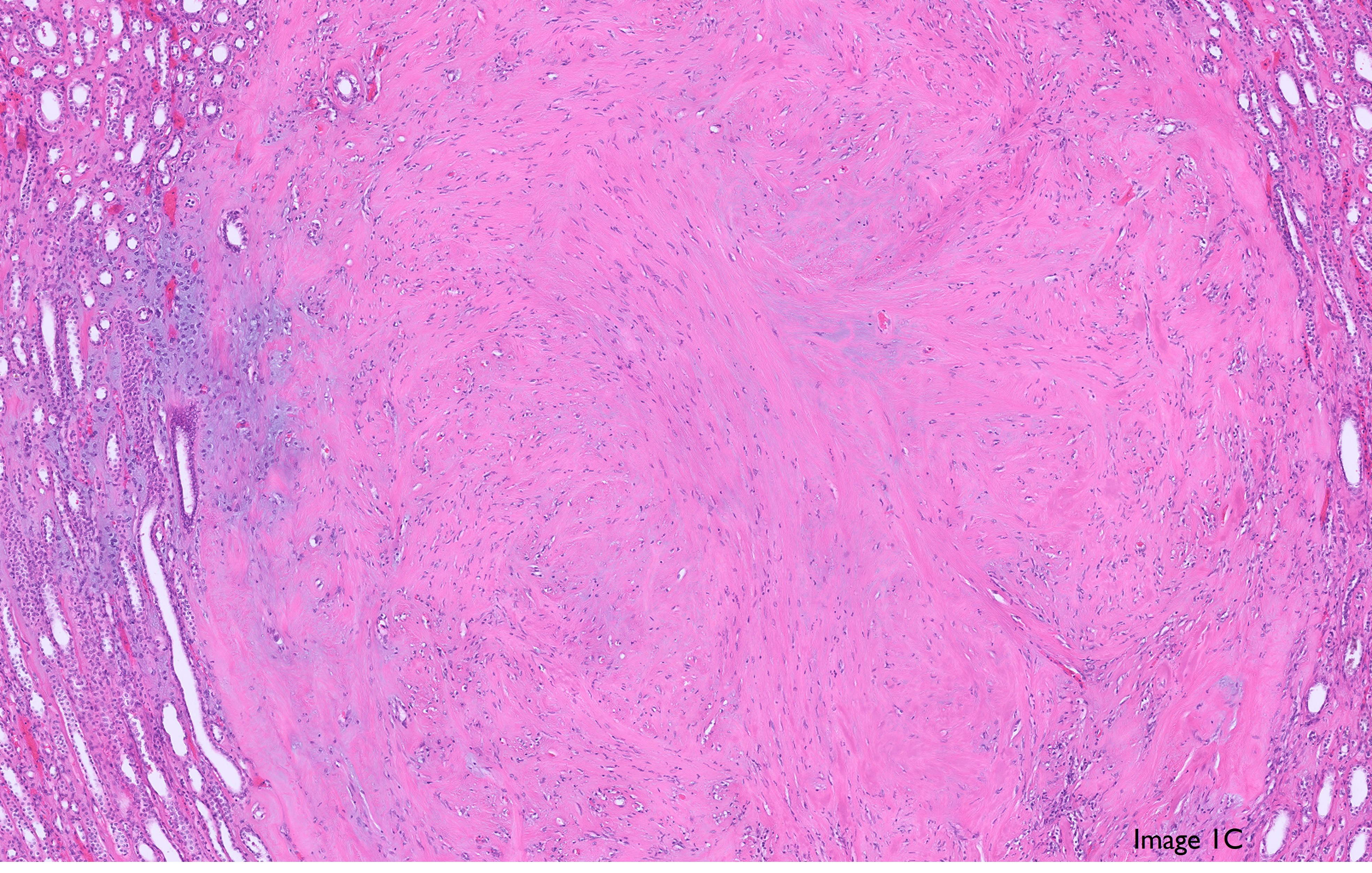 Microscopic image possibly detecting cancerous areas in human tissue