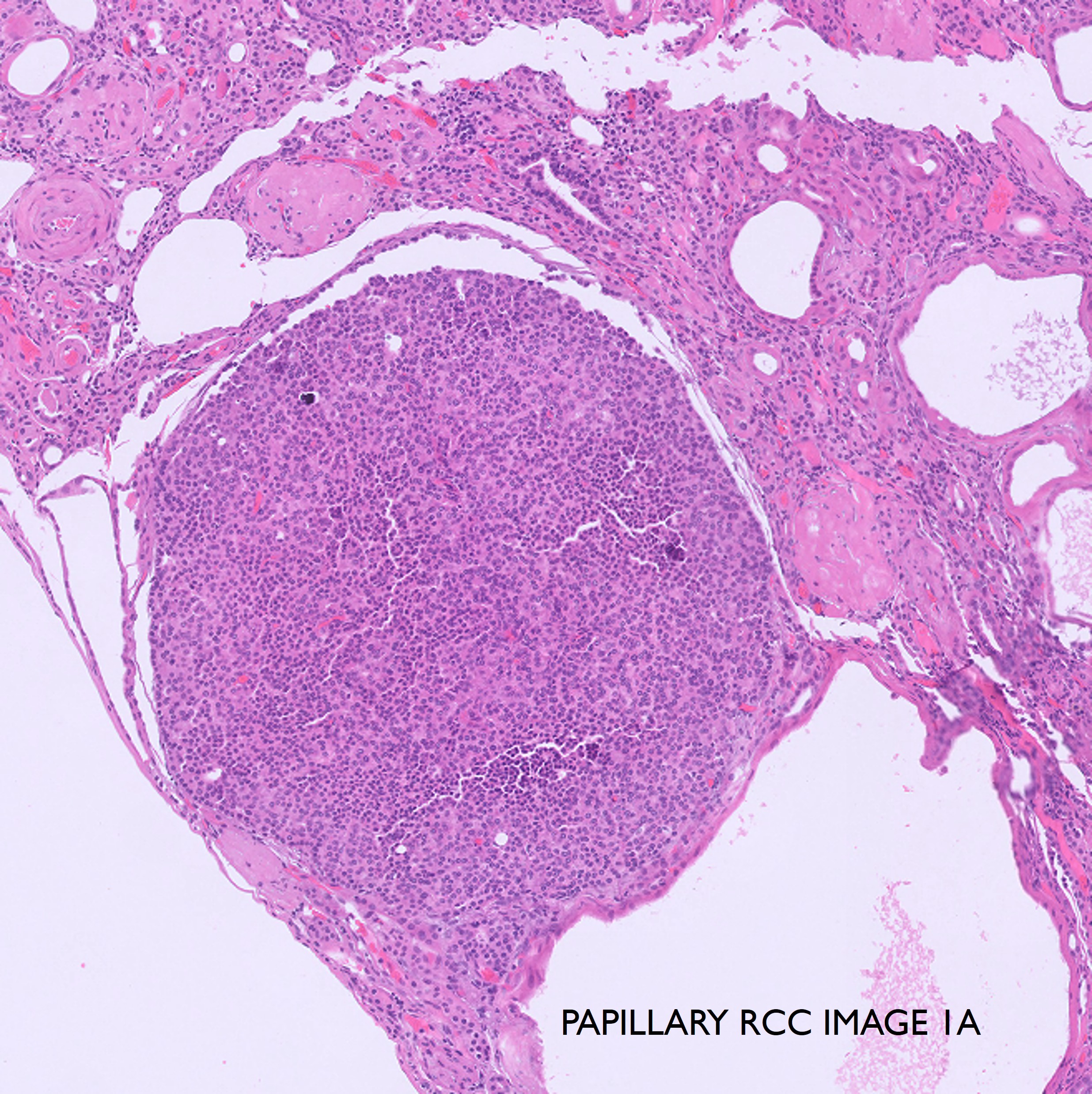 Microscopic image possibly detecting cancerous areas in human tissue
