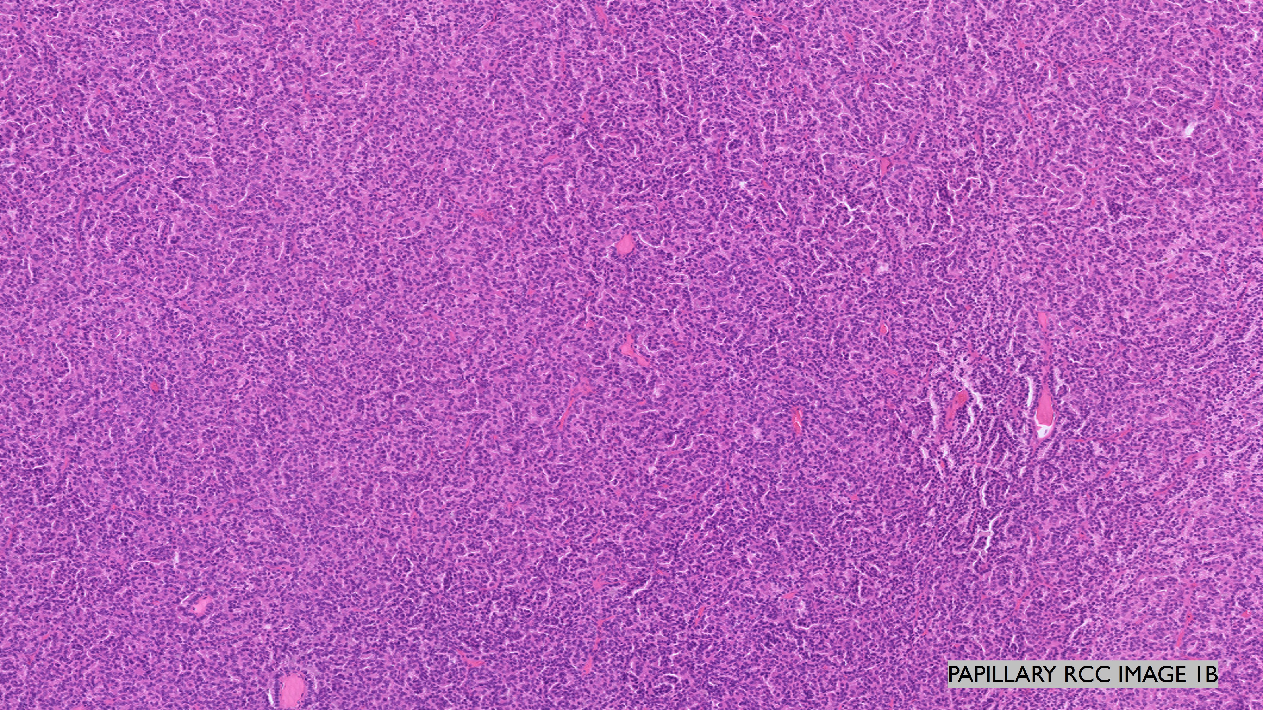 Microscopic image possibly detecting cancerous areas in human tissue