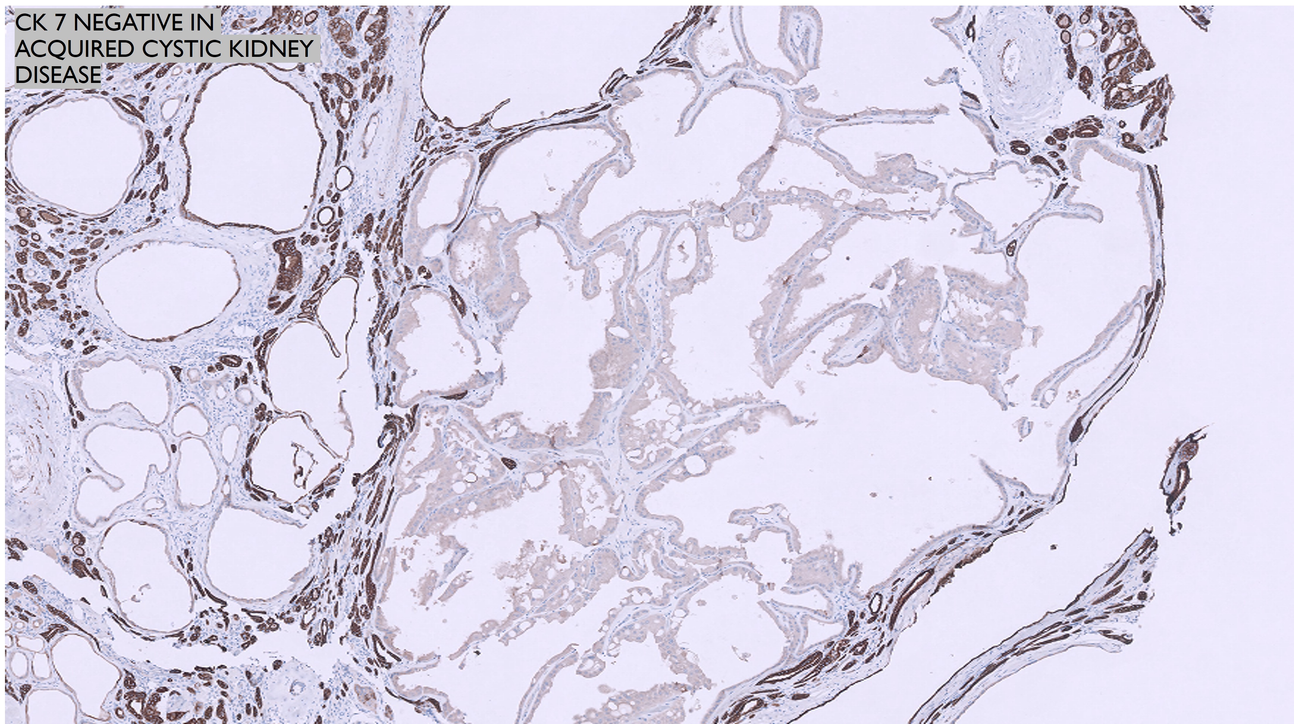 Microscopic image possibly detecting cancerous areas in human tissue