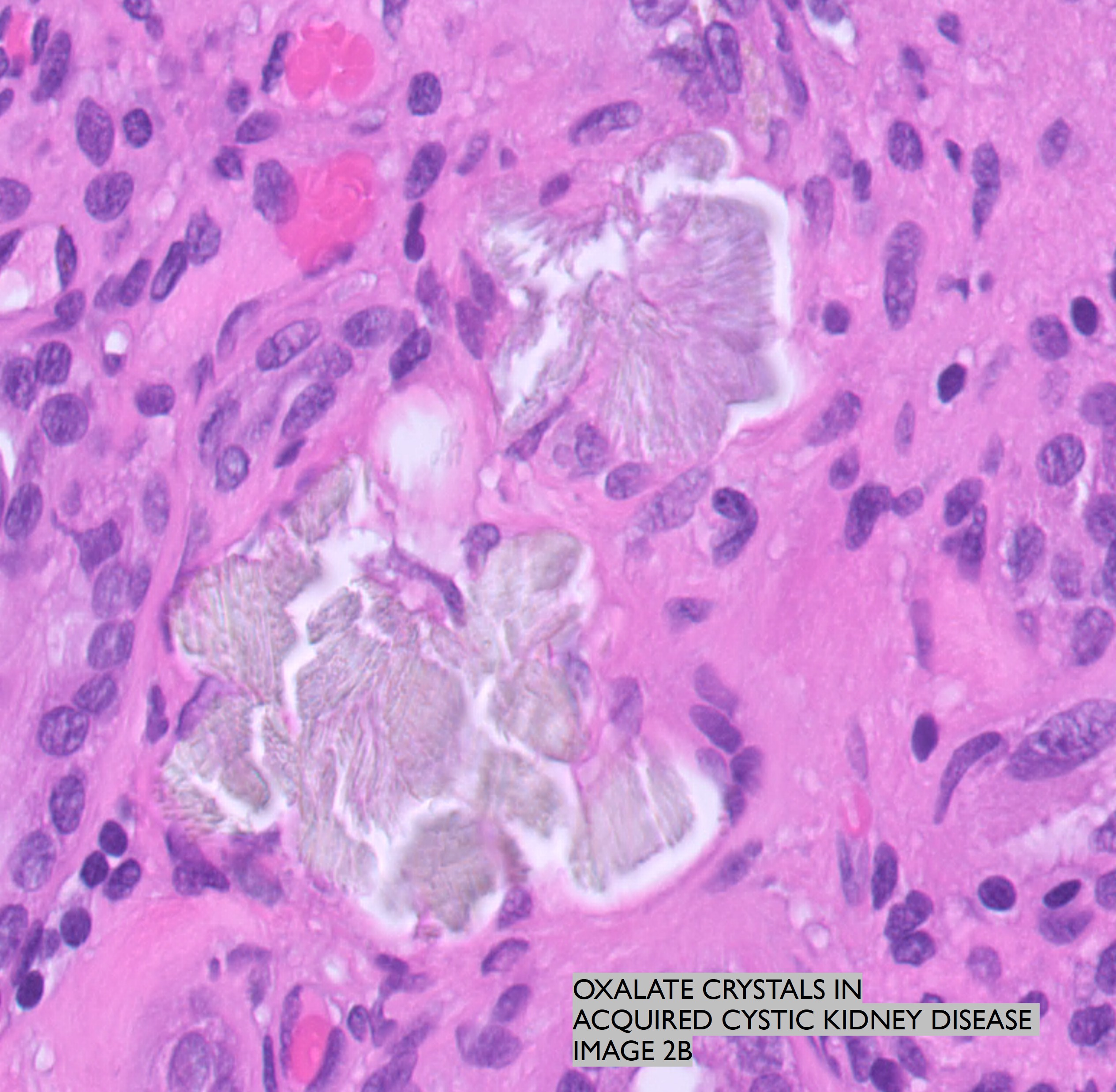Microscopic image possibly detecting cancerous areas in human tissue