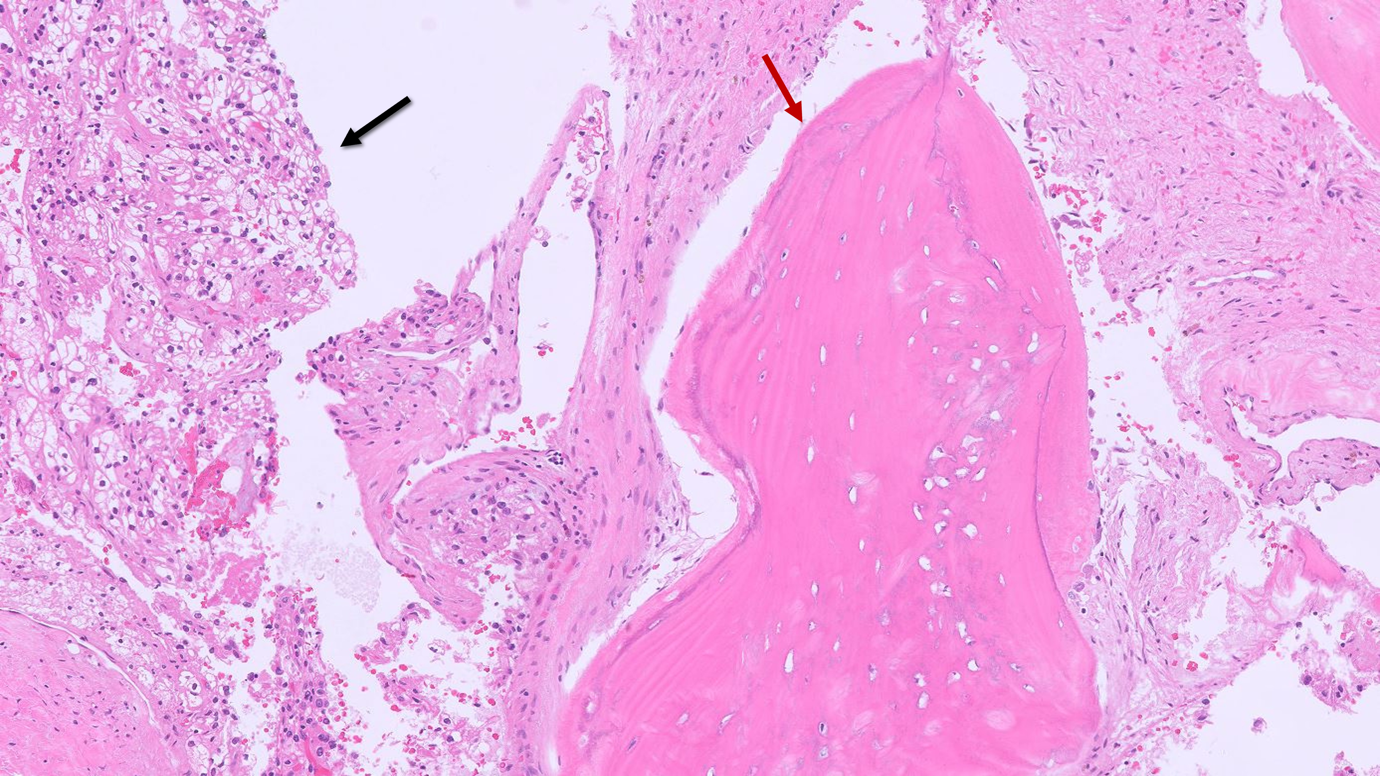 Microscopic image possibly detecting cancerous areas in human tissue