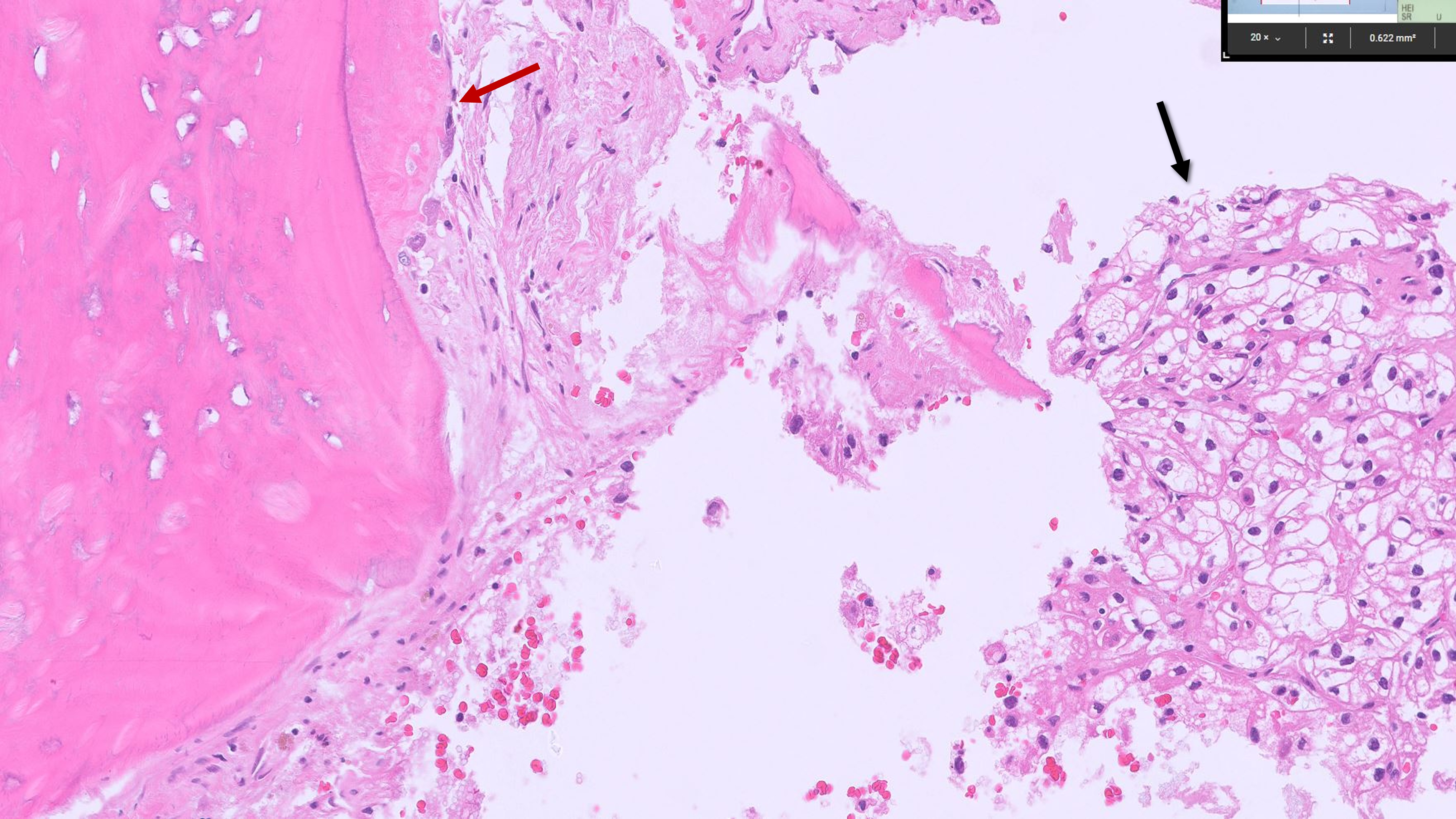 Microscopic image possibly detecting cancerous areas in human tissue