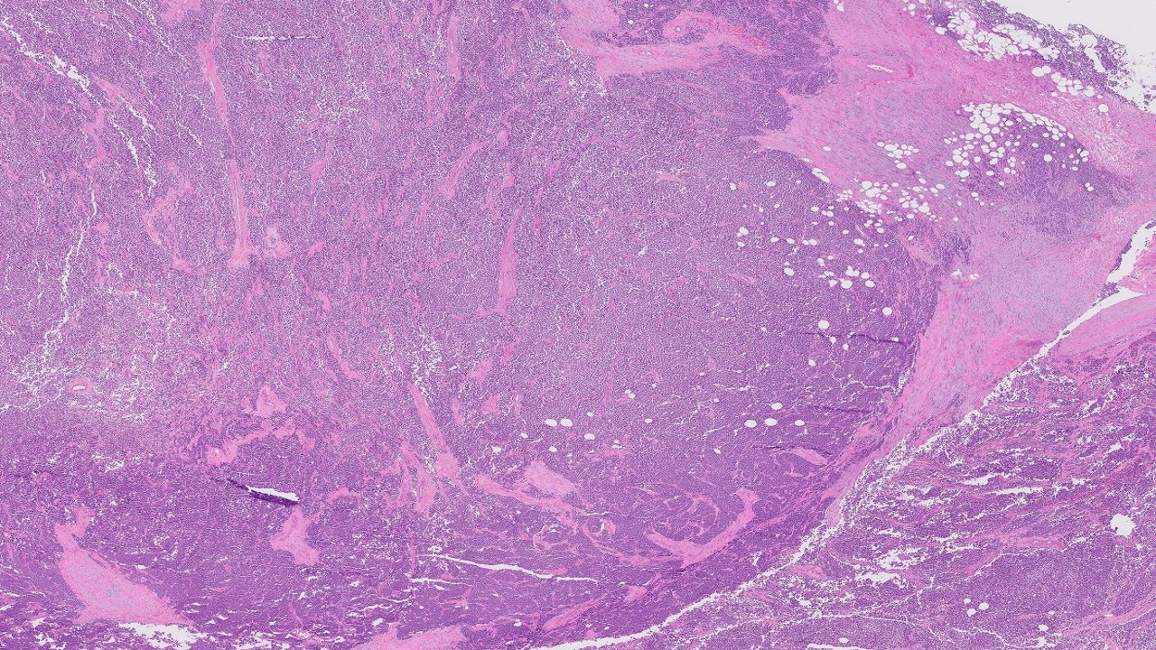 Microscopic image possibly detecting cancerous areas in human tissue