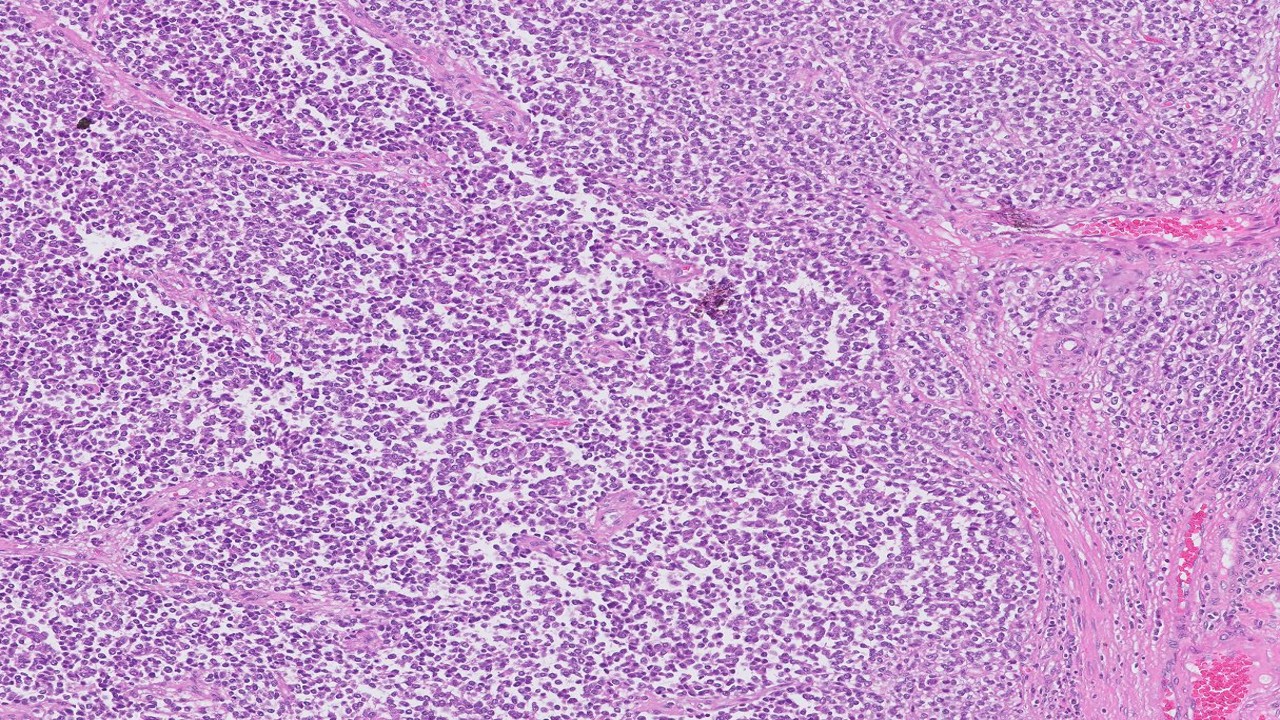 Microscopic image possibly detecting cancerous areas in human tissue