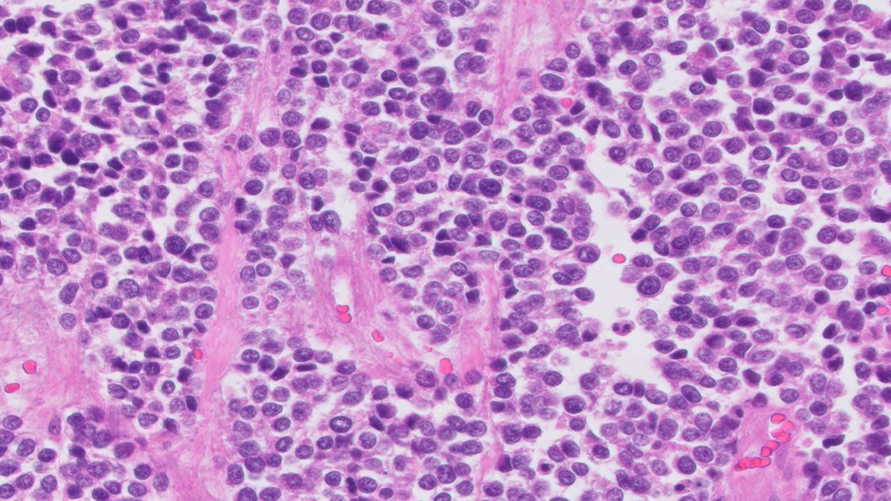 Microscopic image possibly detecting cancerous areas in human tissue