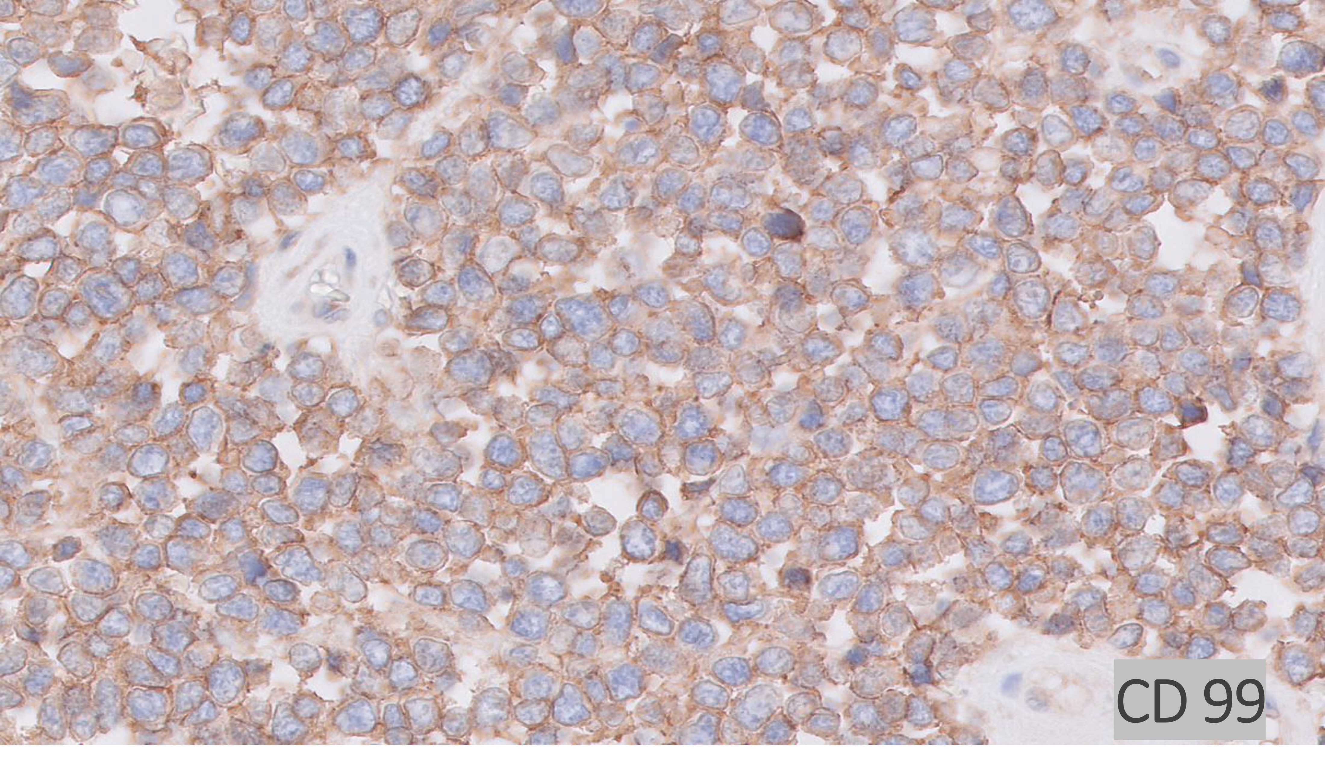 Microscopic image possibly detecting cancerous areas in human tissue