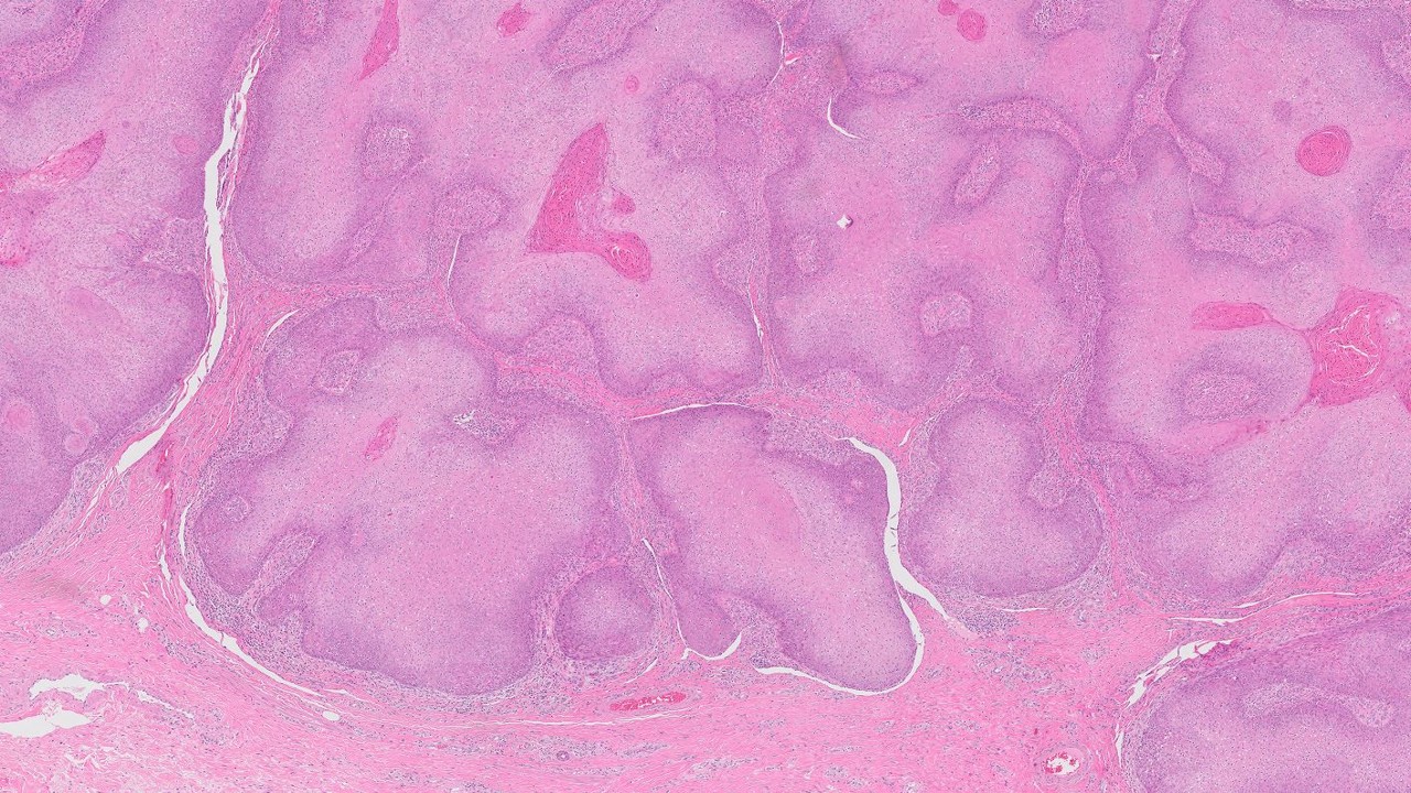 Microscopic image possibly detecting cancerous areas in human tissue