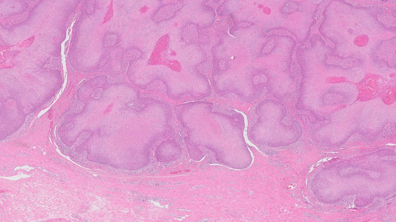 Microscopic image possibly detecting cancerous areas in human tissue