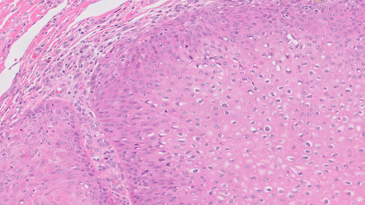 Microscopic image possibly detecting cancerous areas in human tissue