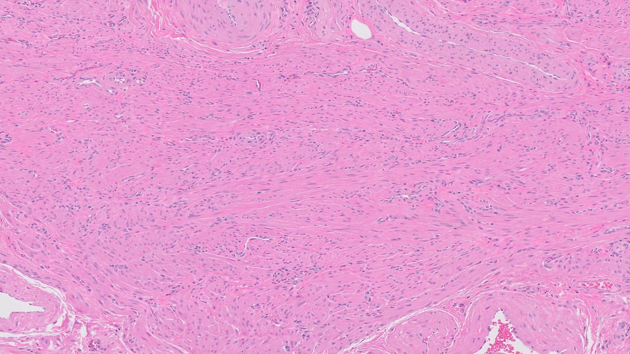 Microscopic image possibly detecting cancerous areas in human tissue