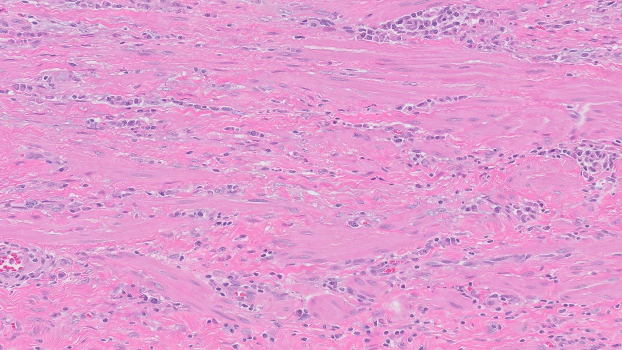 Microscopic image possibly detecting cancerous areas in human tissue