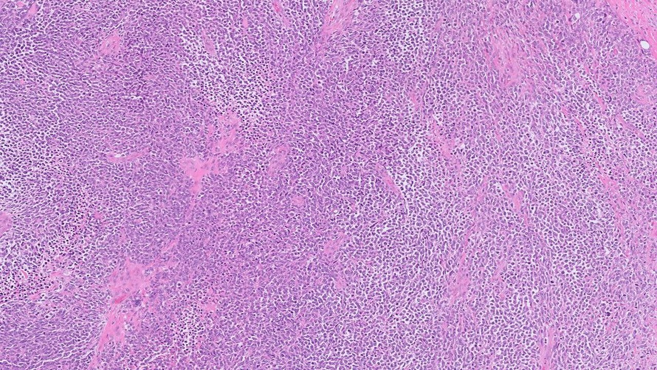 Microscopic image possibly detecting cancerous areas in human tissue