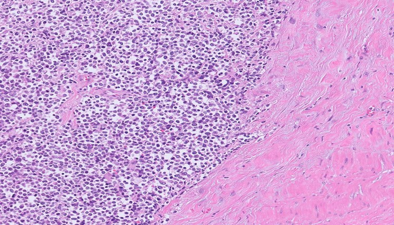 Microscopic image possibly detecting cancerous areas in human tissue
