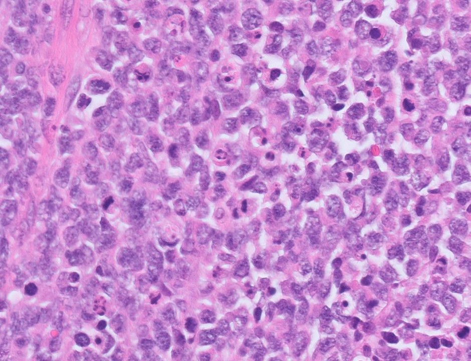 Microscopic image possibly detecting cancerous areas in human tissue